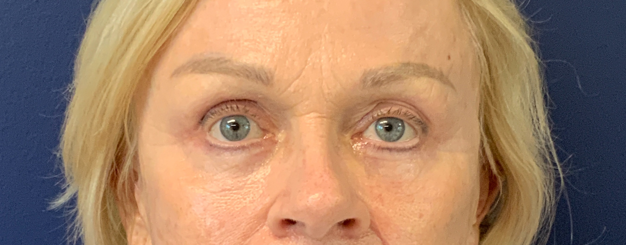 Blepharoplasty-and-Brow-Lift-Case--3108 | After Brow Lift 1
