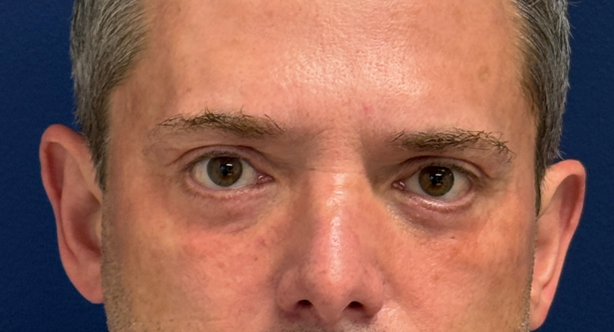 Blepharoplasty-Case--5888 | After Eyelid Surgery 1