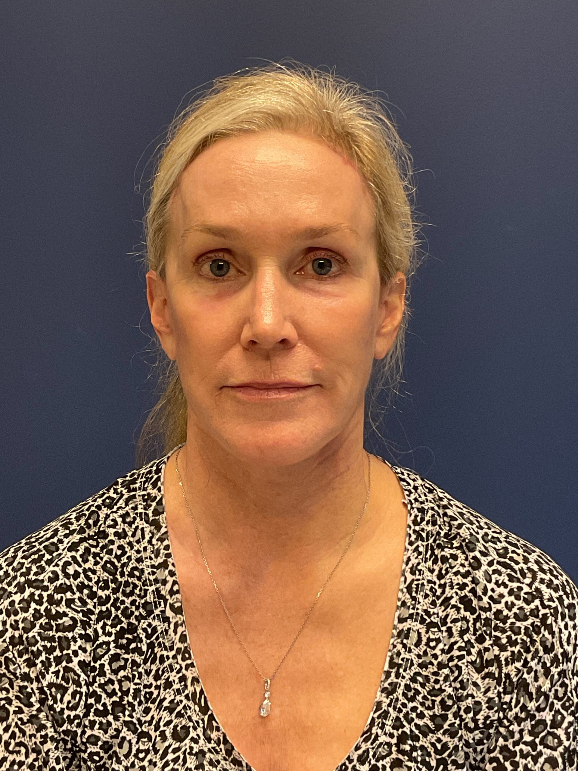 Facelift-Facial-Fat-Grafting-Brow-and-Neck-Lift-Case--9593 | After Facelift 1