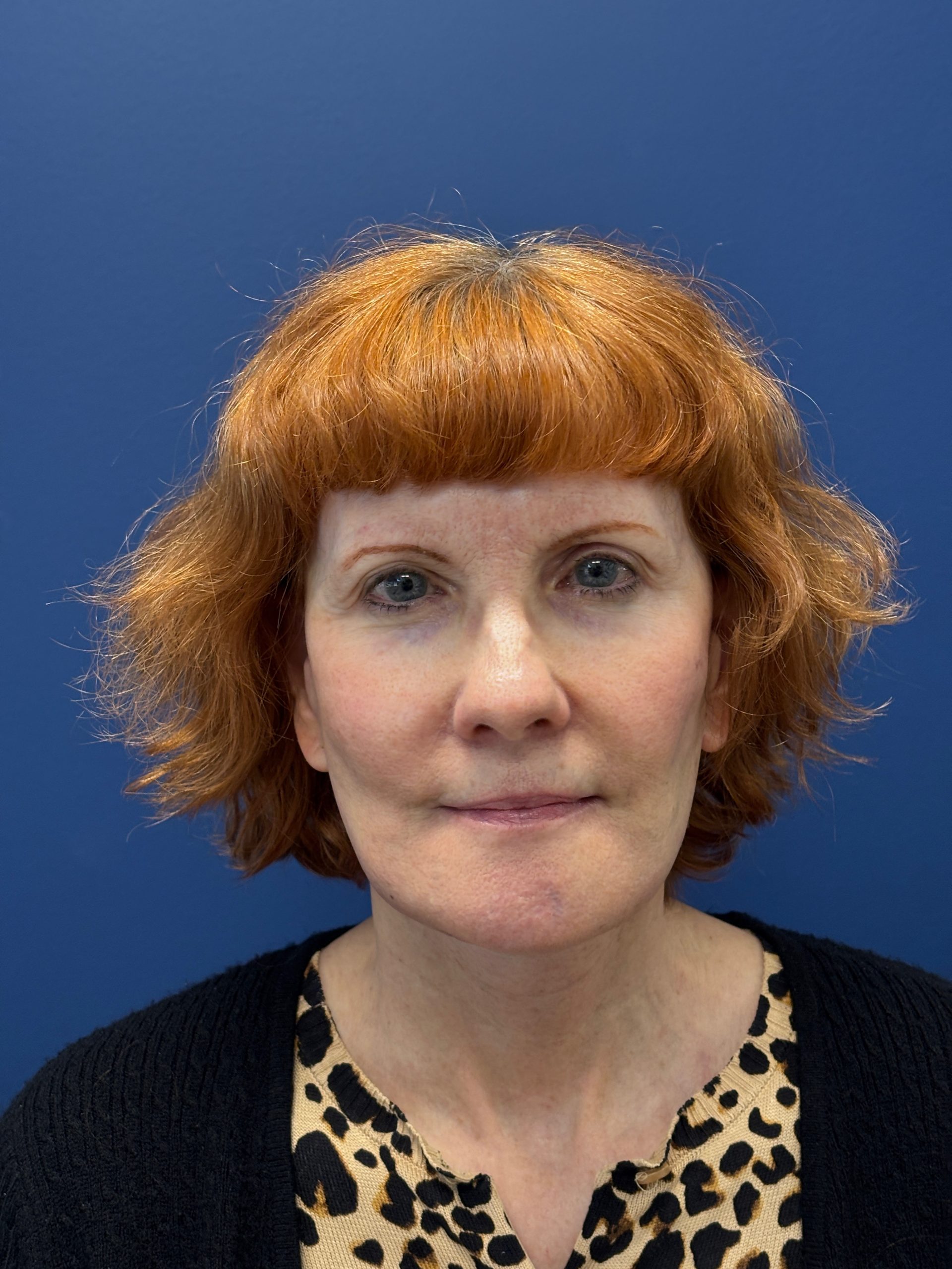 Facelift-Facial-Fat-Grafting-Neck-Lift-Case--6778 | After Facial Fat Grafting 1