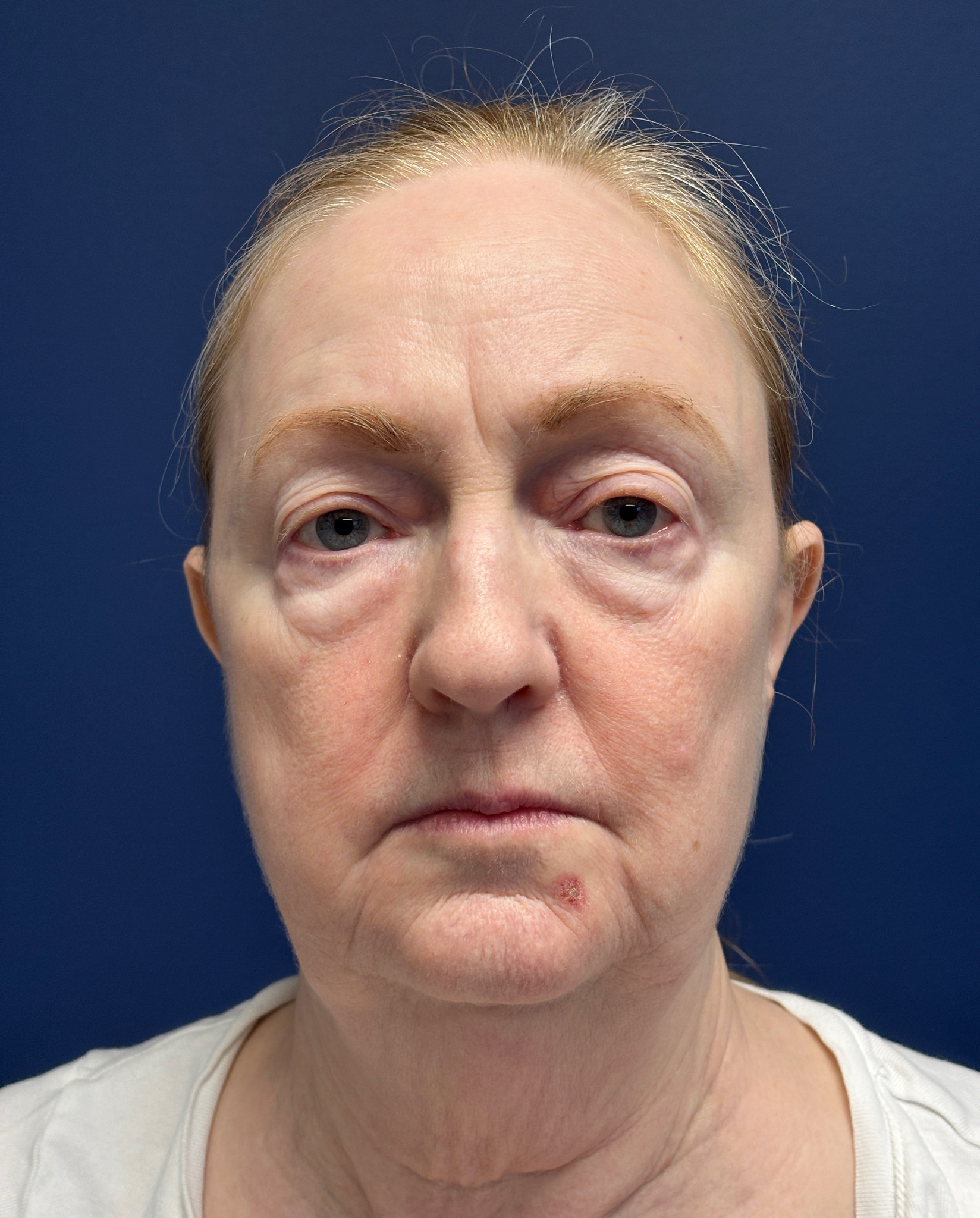 Facelift-Facial-Fat-Graft-Blepharoplasty-Necklift-Case--7934 | Before Facial Fat Grafting 1
