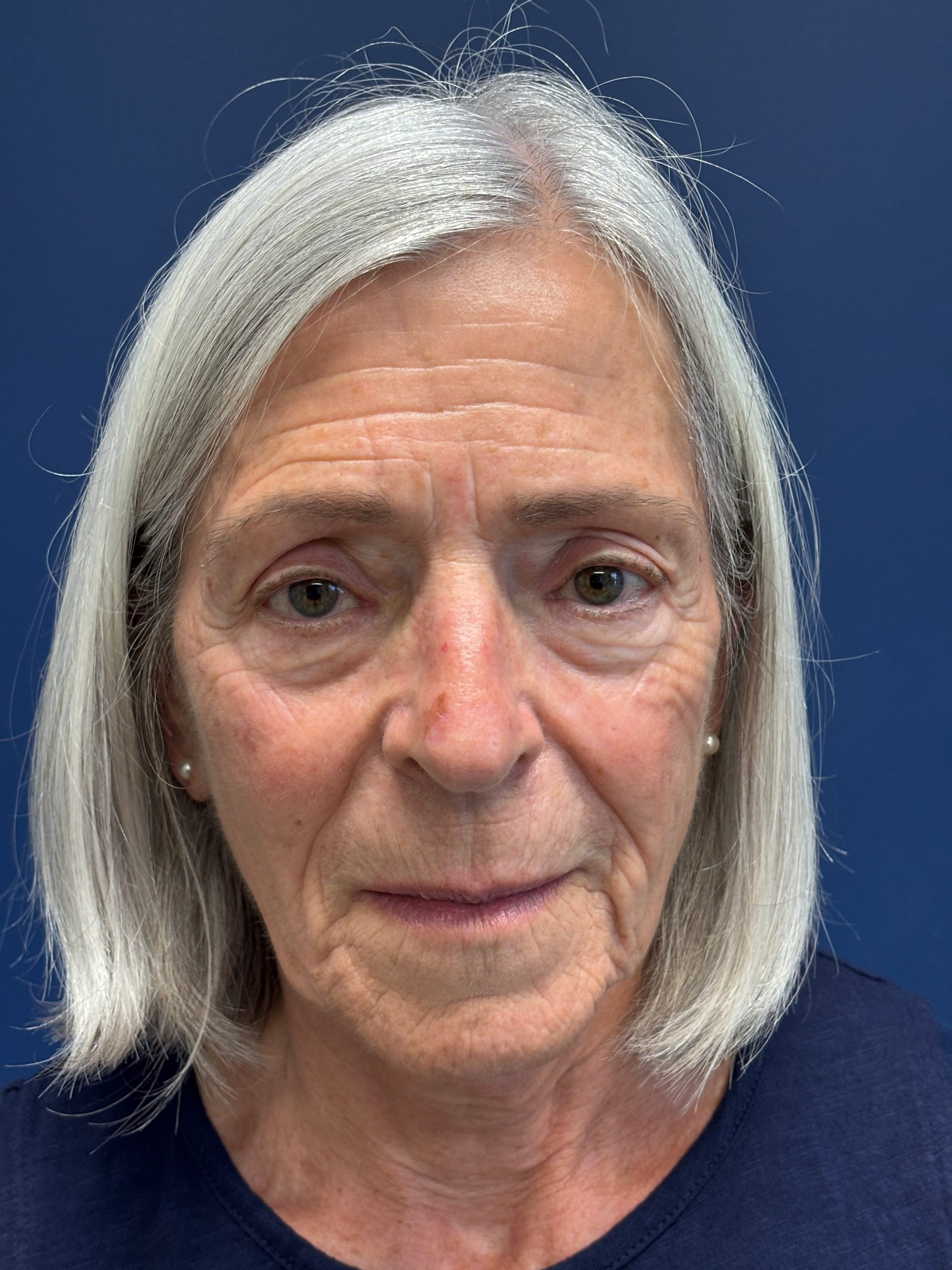 Facelift-Facial-Fat-Grafting-Browlift-Blepharoplasty-Necklift-Case--4176 | Before Facial Fat Grafting 1