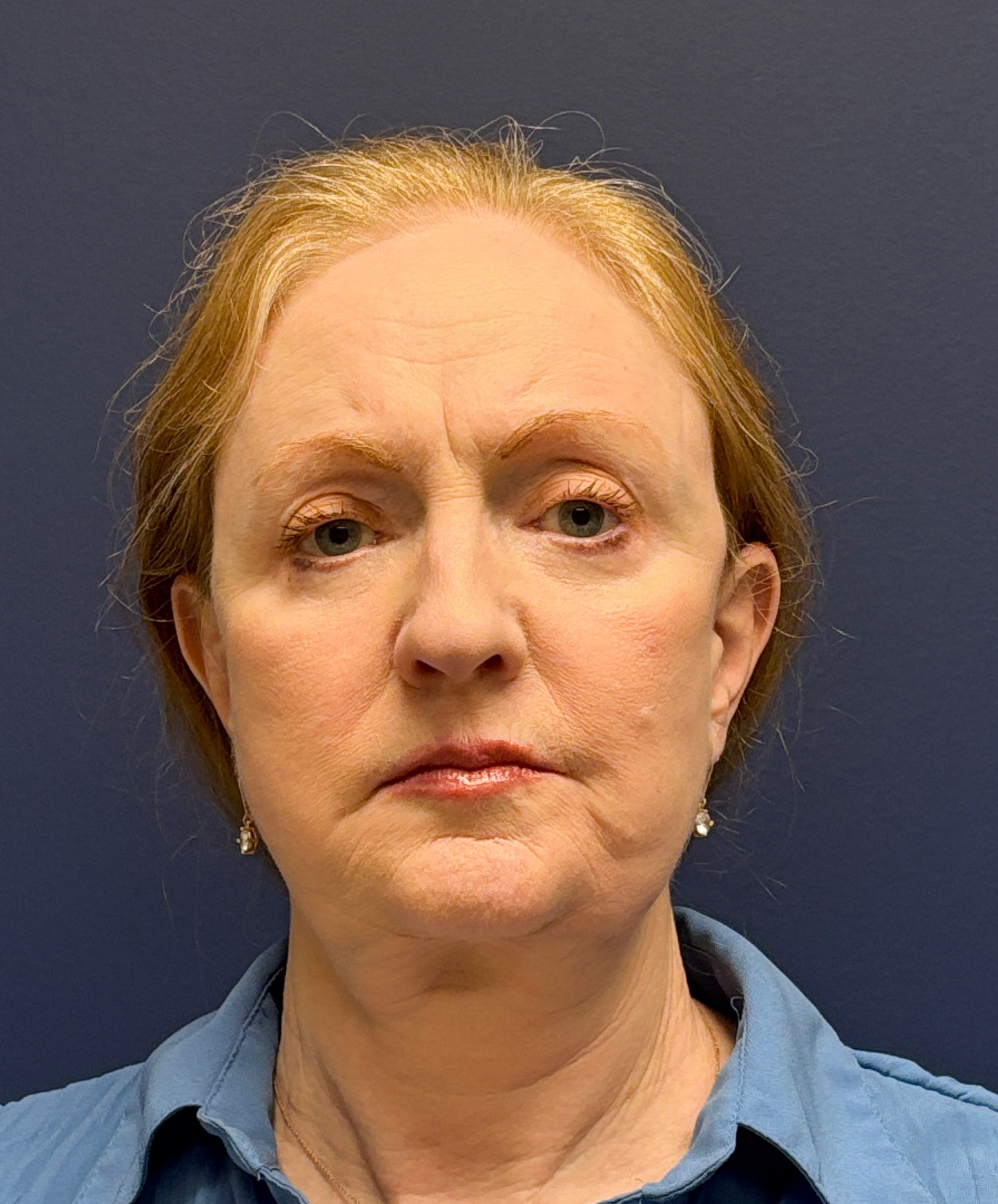 Facelift-Facial-Fat-Graft-Blepharoplasty-Necklift-Case--7934 | After Facial Fat Grafting 1