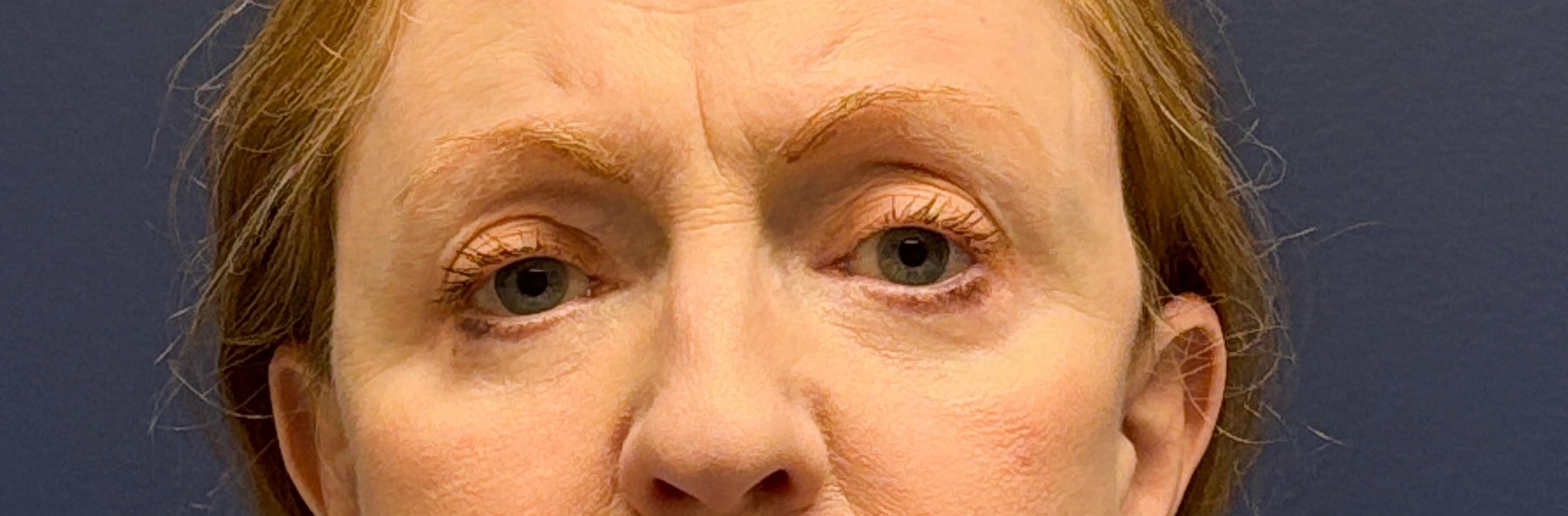 Blepharoplasty-Case--2019 | After Eyelid Surgery 1