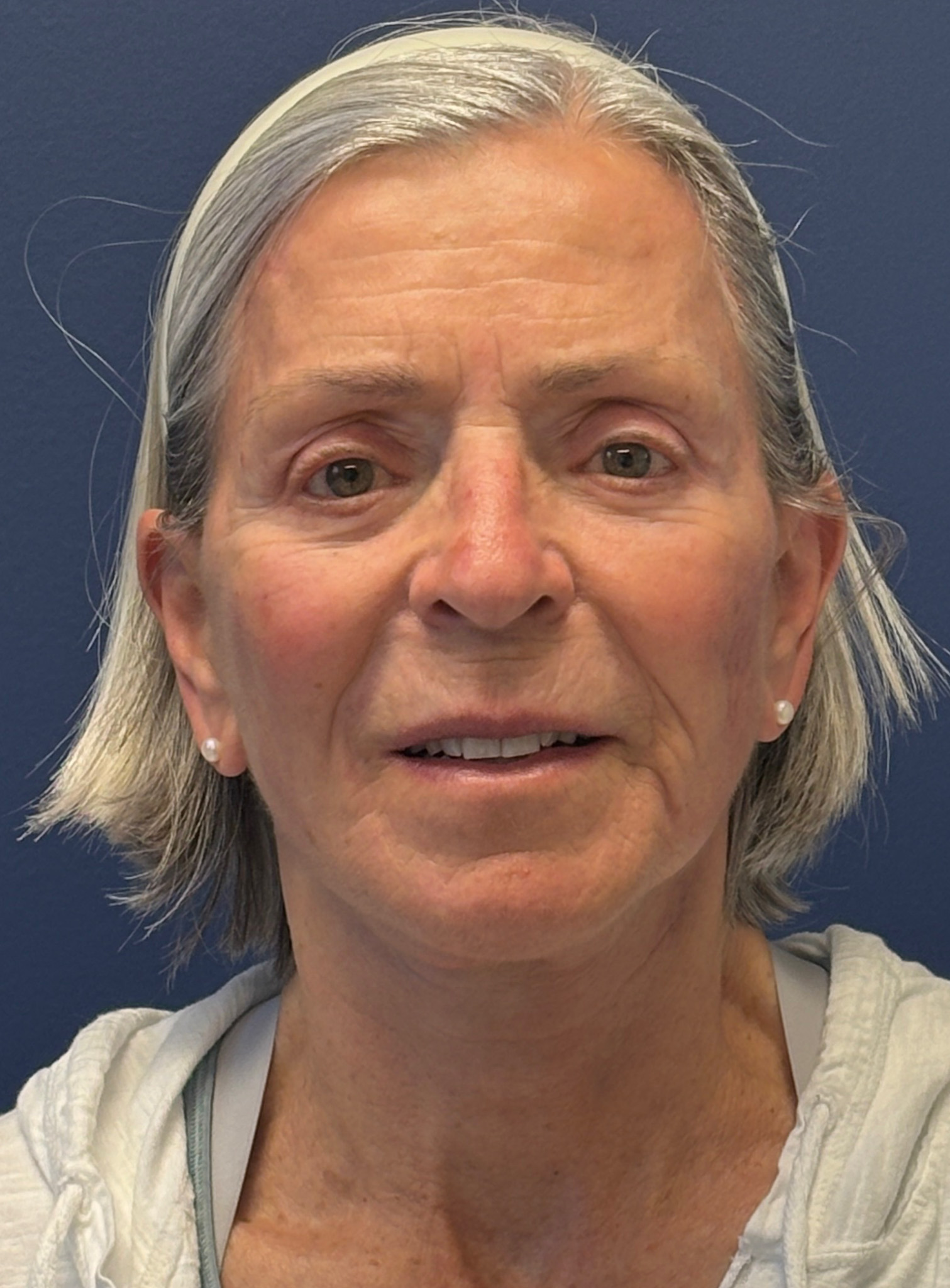 Facelift-Facial-Fat-Grafting-Browlift-Blepharoplasty-Necklift-Case--4176 | After Facial Fat Grafting 1