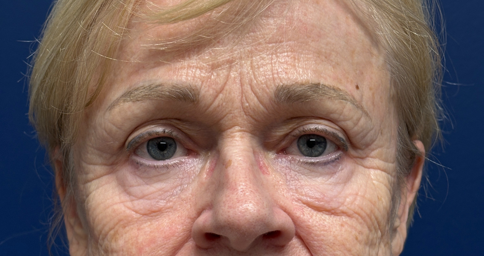 Blepharoplasty-and-Brow-Lift-Case--3108 | Before Brow Lift 1