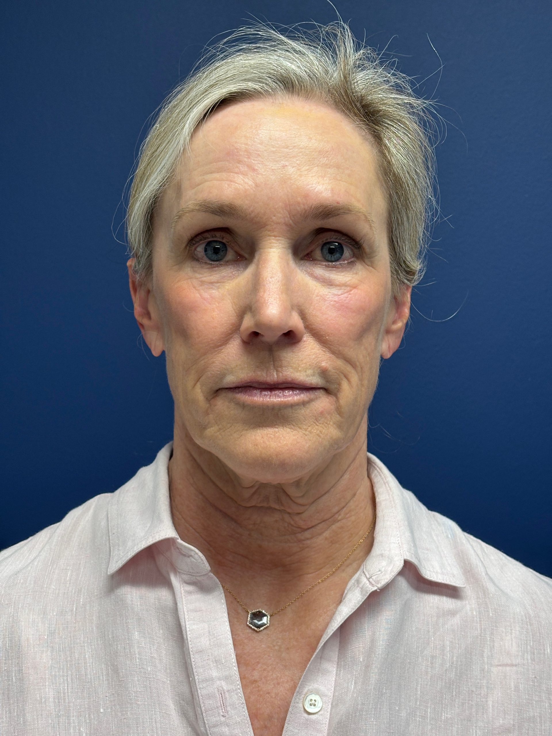 Facelift-Facial-Fat-Grafting-Brow-and-Neck-Lift-Case--9593 | Before Facelift 1