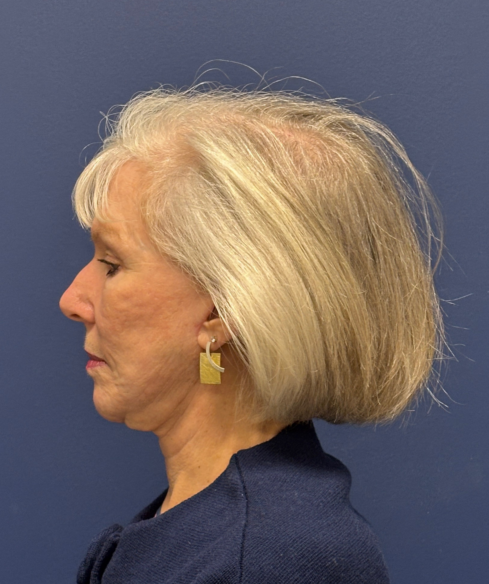 Facelift-Facial-Fat-Grafting-Neck-Lift-Case--1414 | After Facial Fat Grafting 2