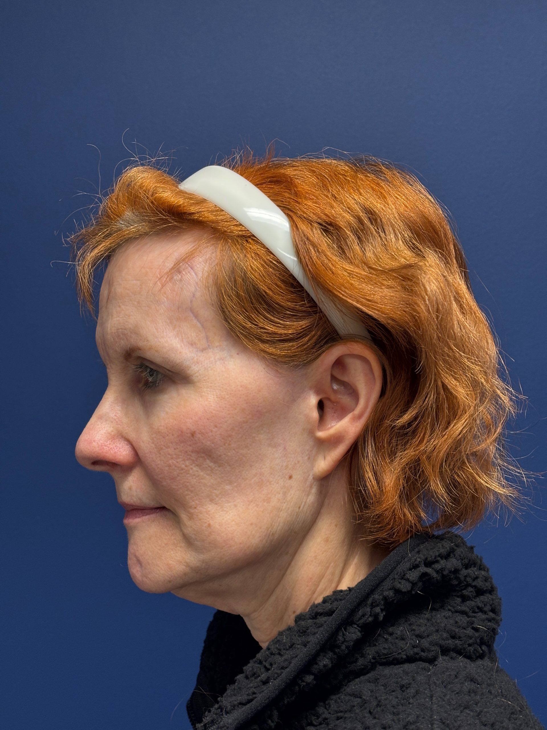 Facelift-Facial-Fat-Grafting-Neck-Lift-Case--6778 | Before Facial Fat Grafting 2
