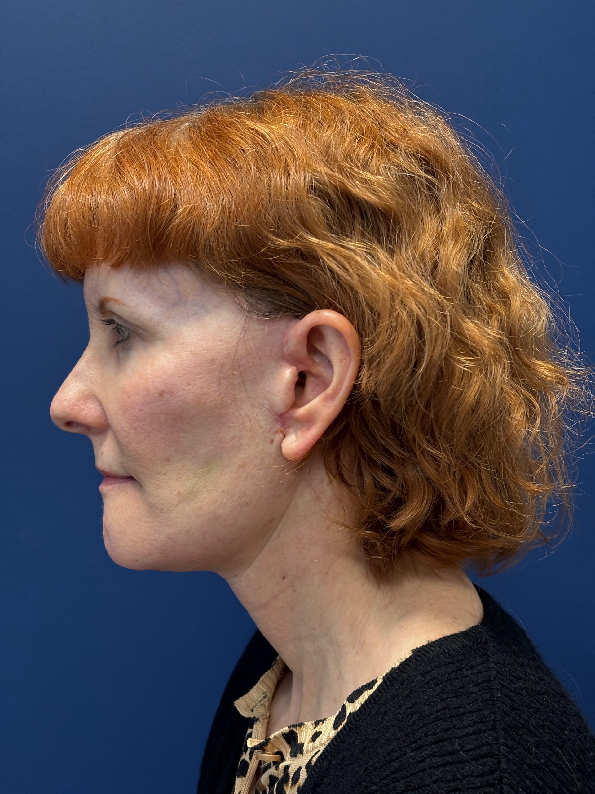 Facelift-Facial-Fat-Grafting-Neck-Lift-Case--6778 | After Facial Fat Grafting 2