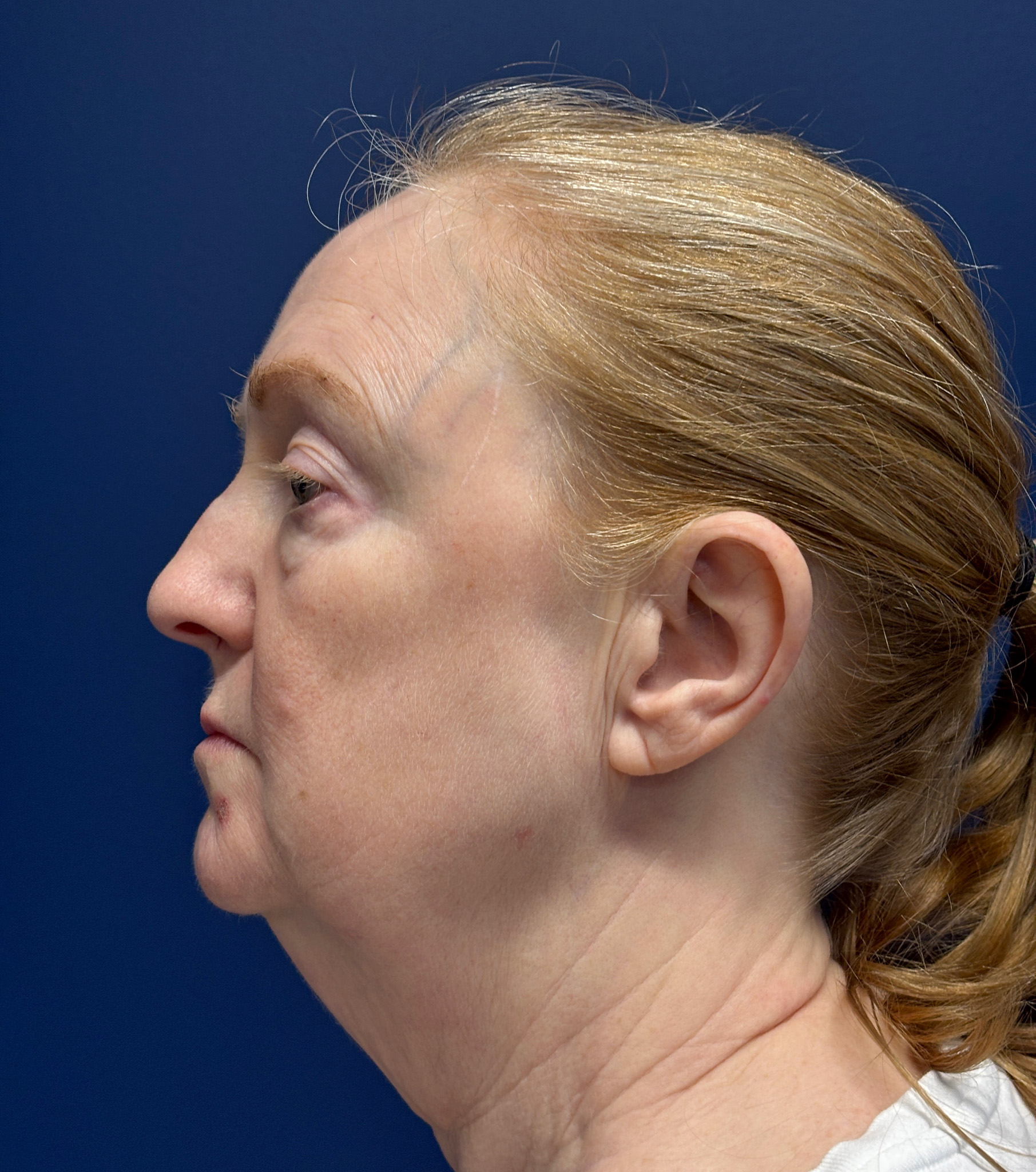 Facelift-Facial-Fat-Graft-Blepharoplasty-Necklift-Case--7934 | Before Facial Fat Grafting 2