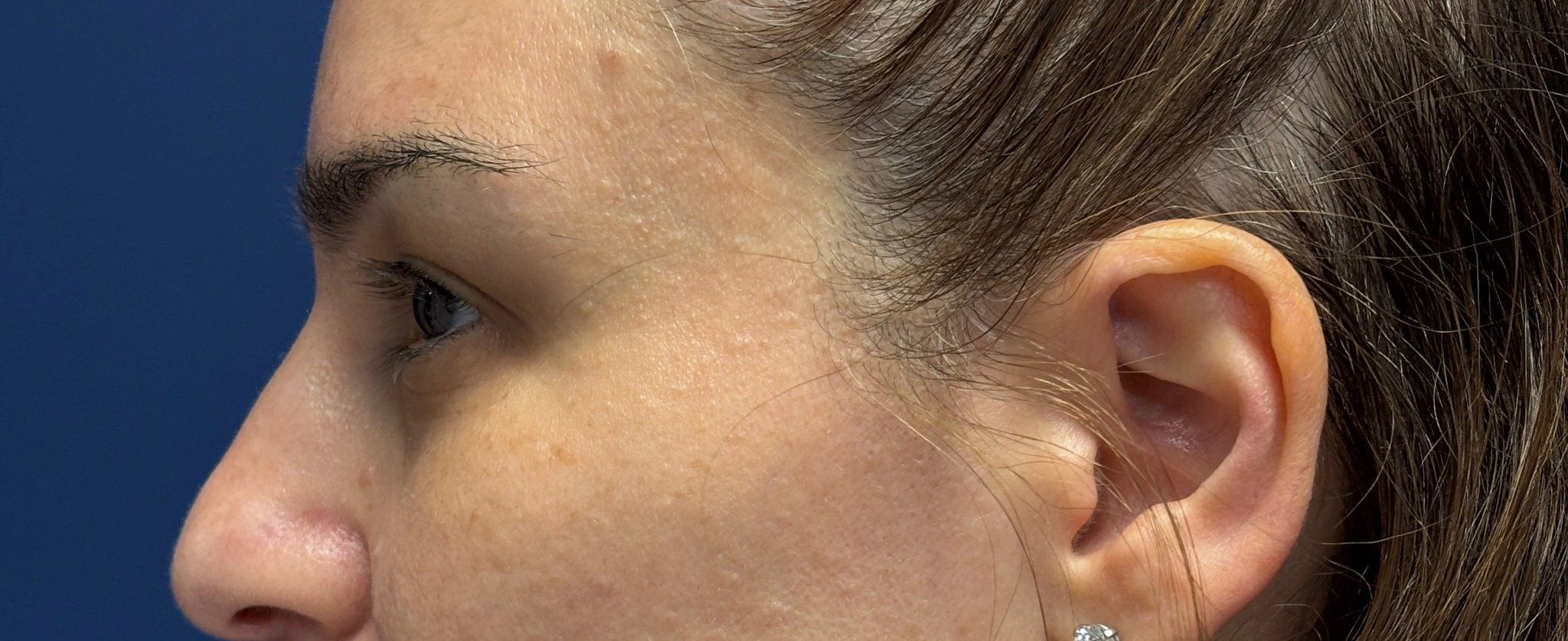 Blepharoplasty-Case--5118 | Before Dr. Arjun Kanuri 2