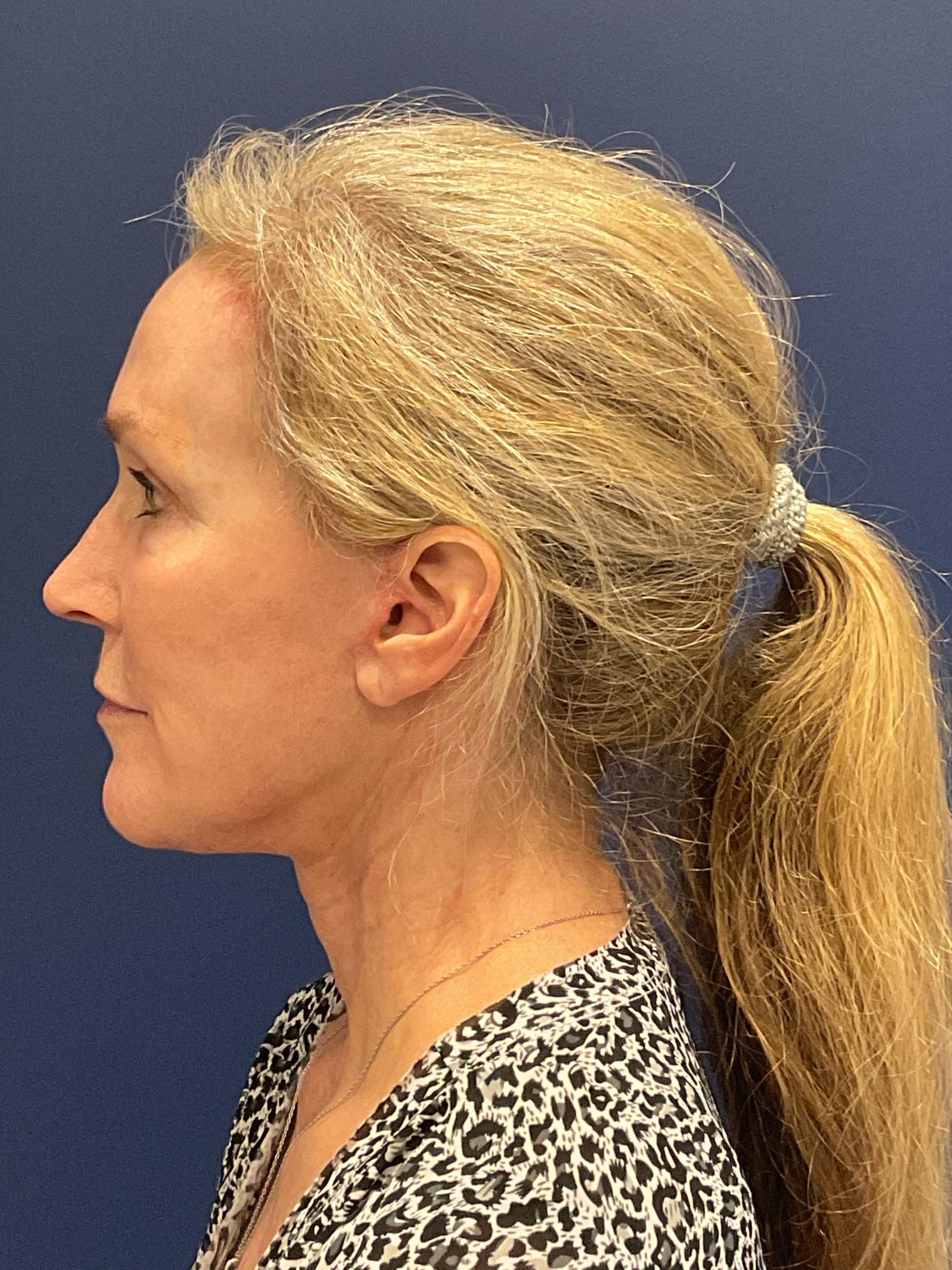 Facelift-Facial-Fat-Grafting-Brow-and-Neck-Lift-Case--9593 | After Brow Lift 3
