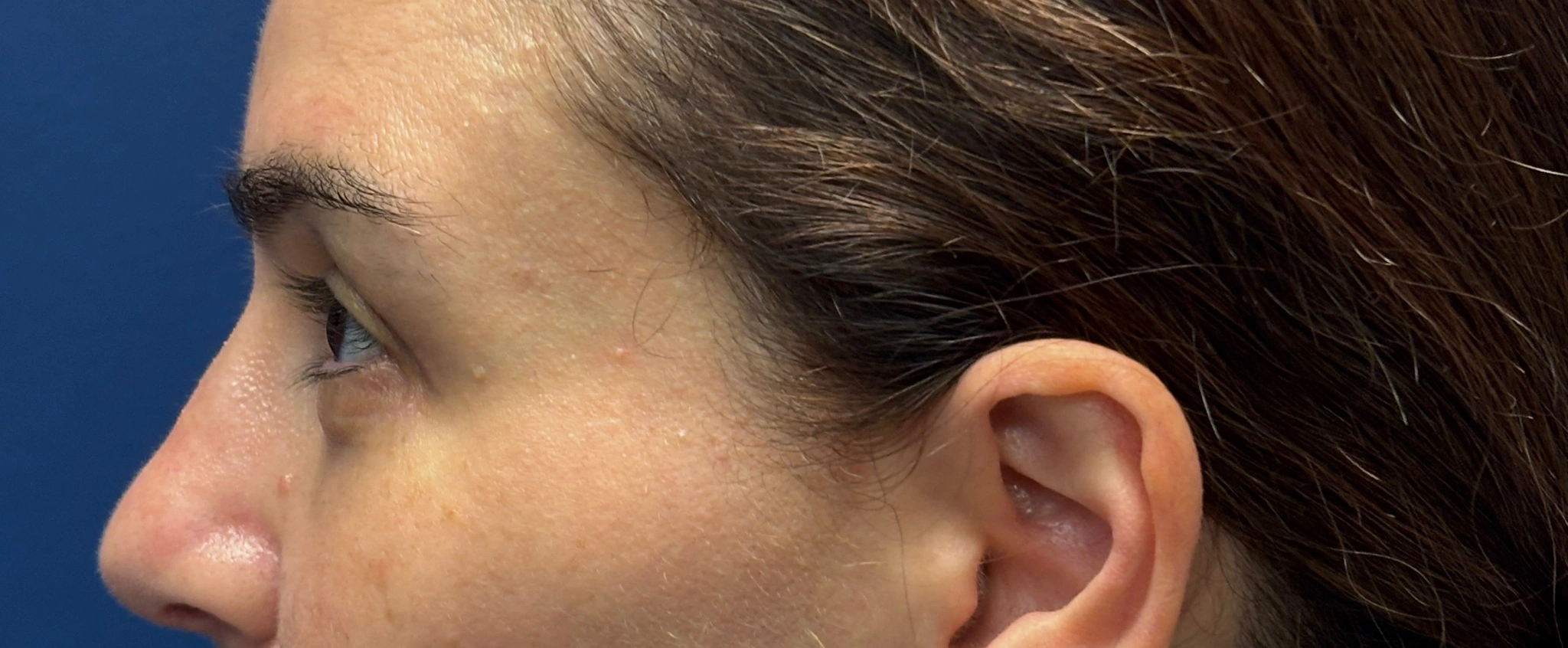 Blepharoplasty-Case--5118 | After Dr. Arjun Kanuri 2
