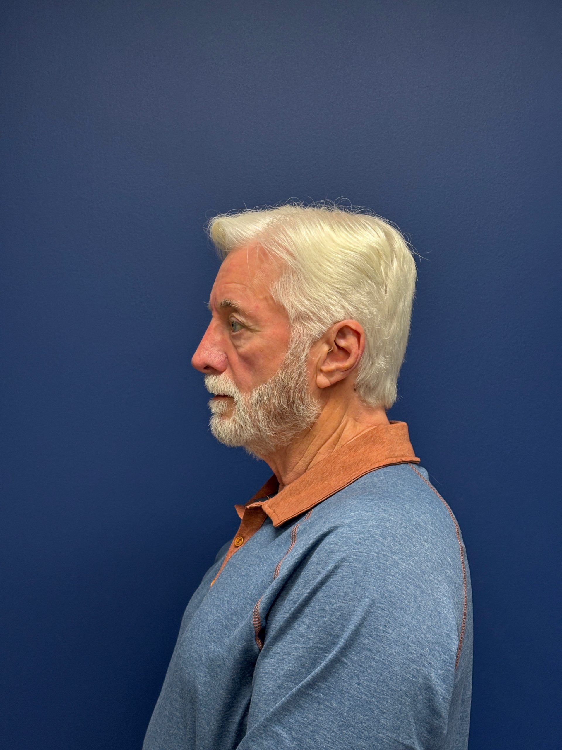Facelift-Facial-Fat-Graft-Blepheroplasty-Necklift-Case--7796 | Before Face 2