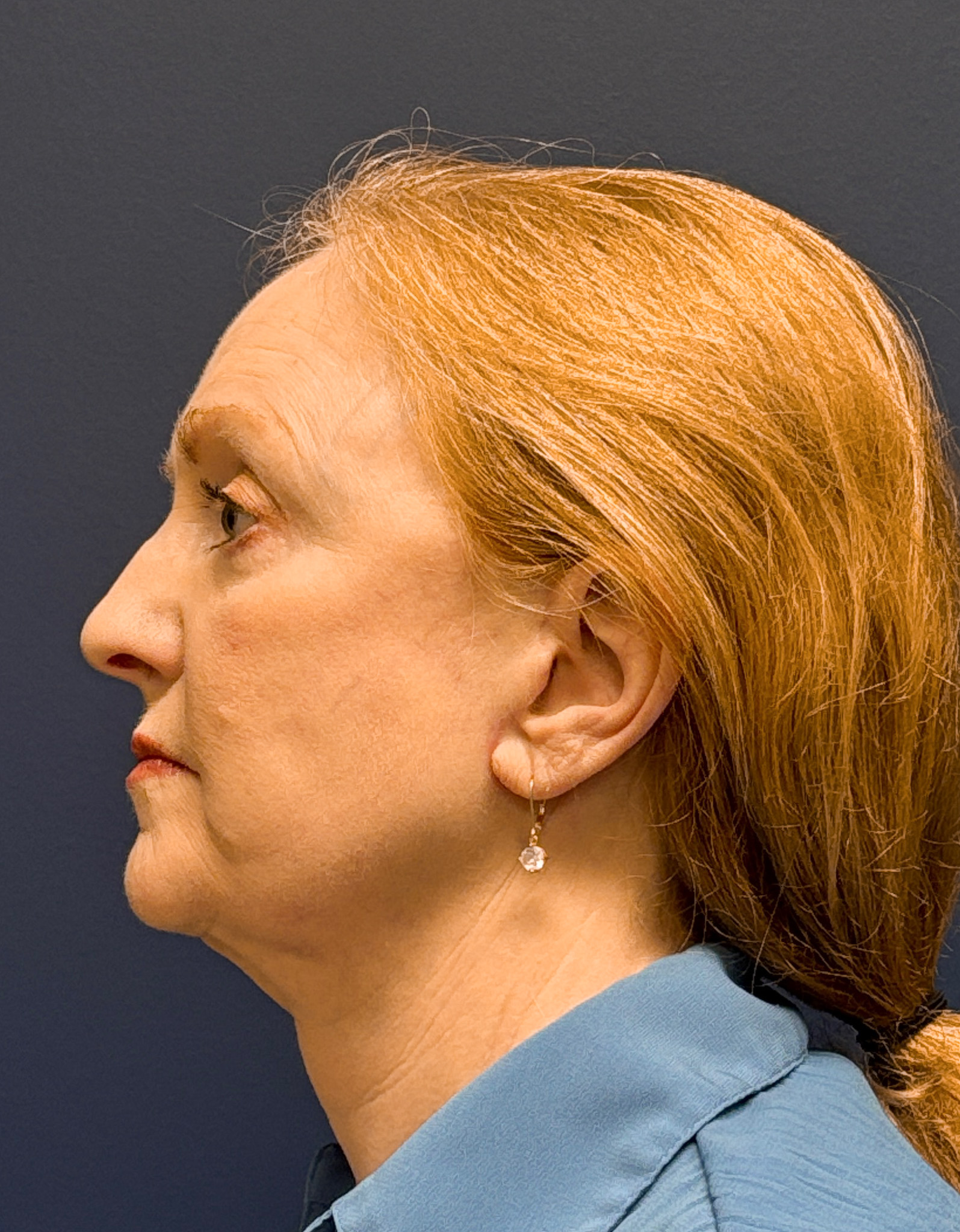 Facelift-Facial-Fat-Graft-Blepharoplasty-Necklift-Case--7934 | After Facial Fat Grafting 2