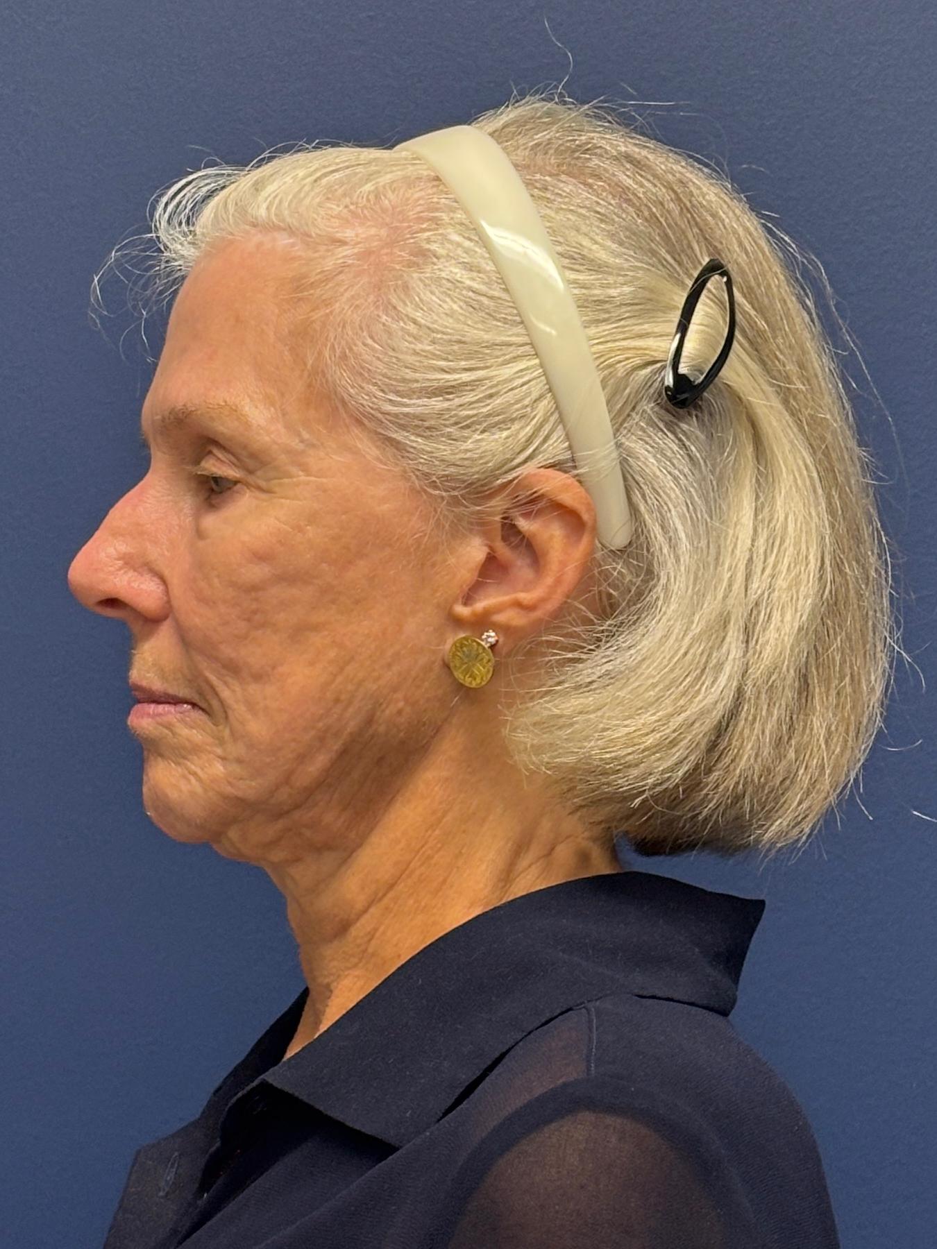 Facelift-Facial-Fat-Grafting-Neck-Lift-Case--1414 | Before Facial Fat Grafting 2