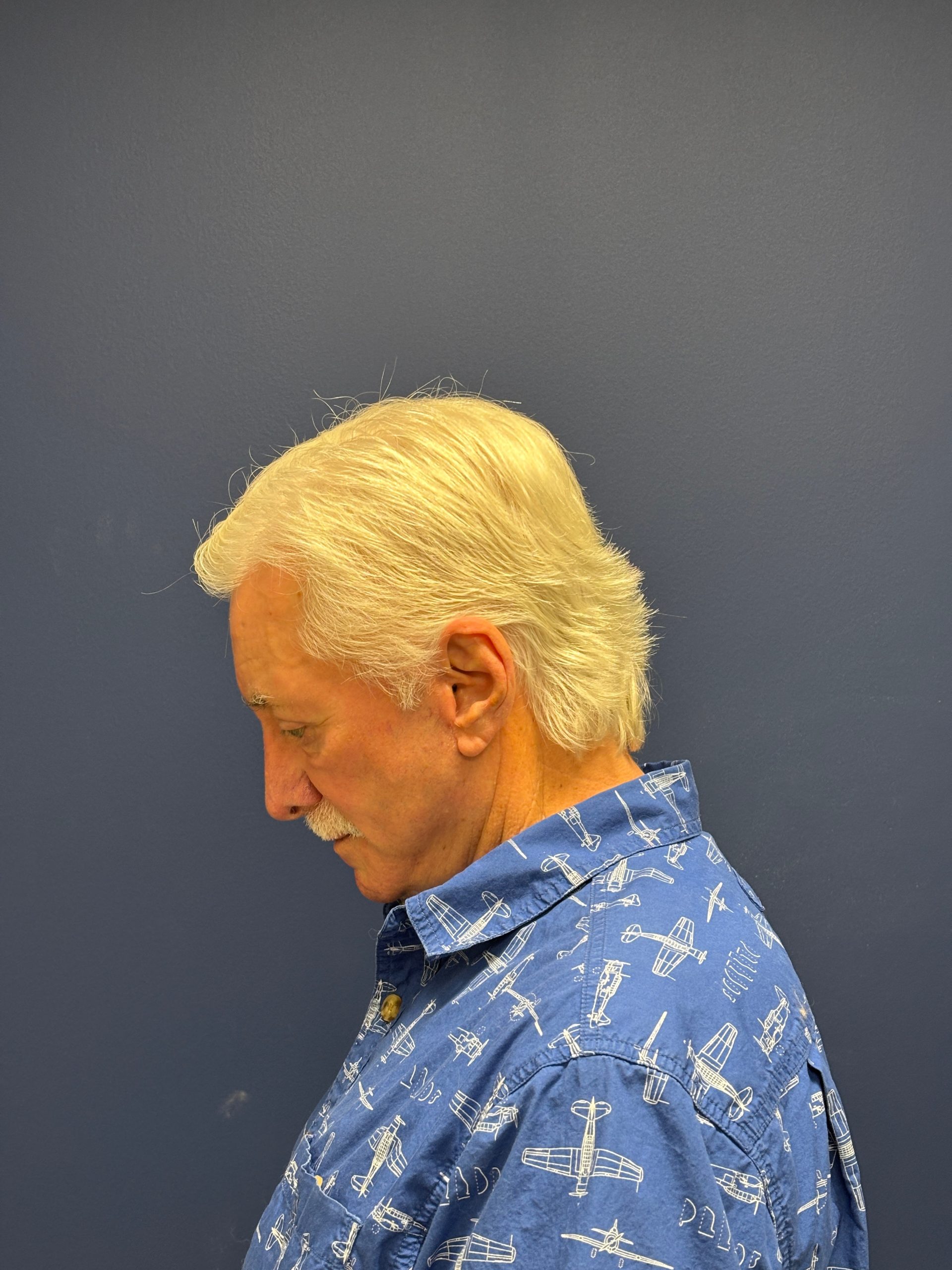 Facelift-Facial-Fat-Graft-Blepheroplasty-Necklift-Case--7796 | After Eyelid Surgery 6