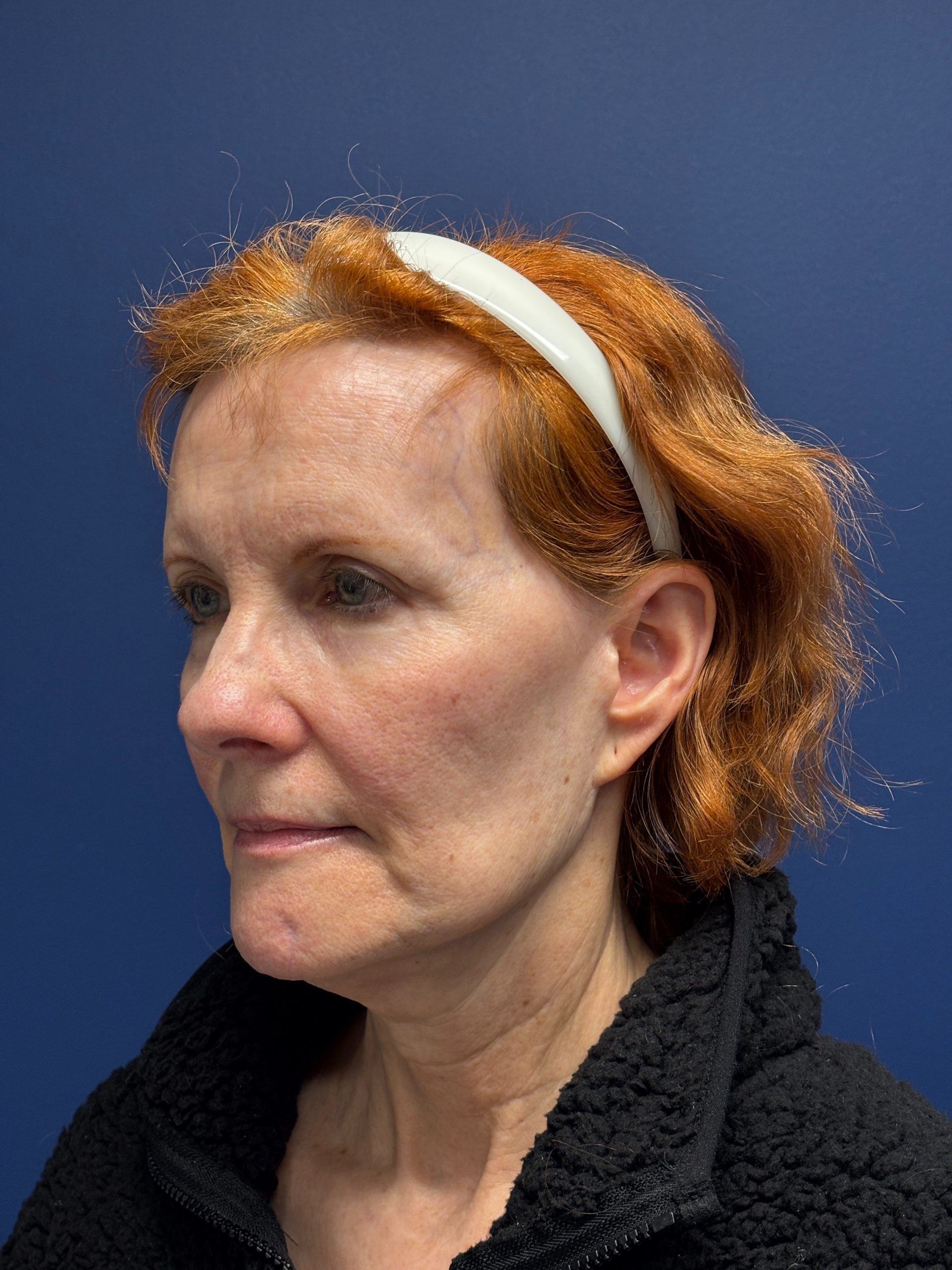 Facelift-Facial-Fat-Grafting-Neck-Lift-Case--6778 | Before Face360 4