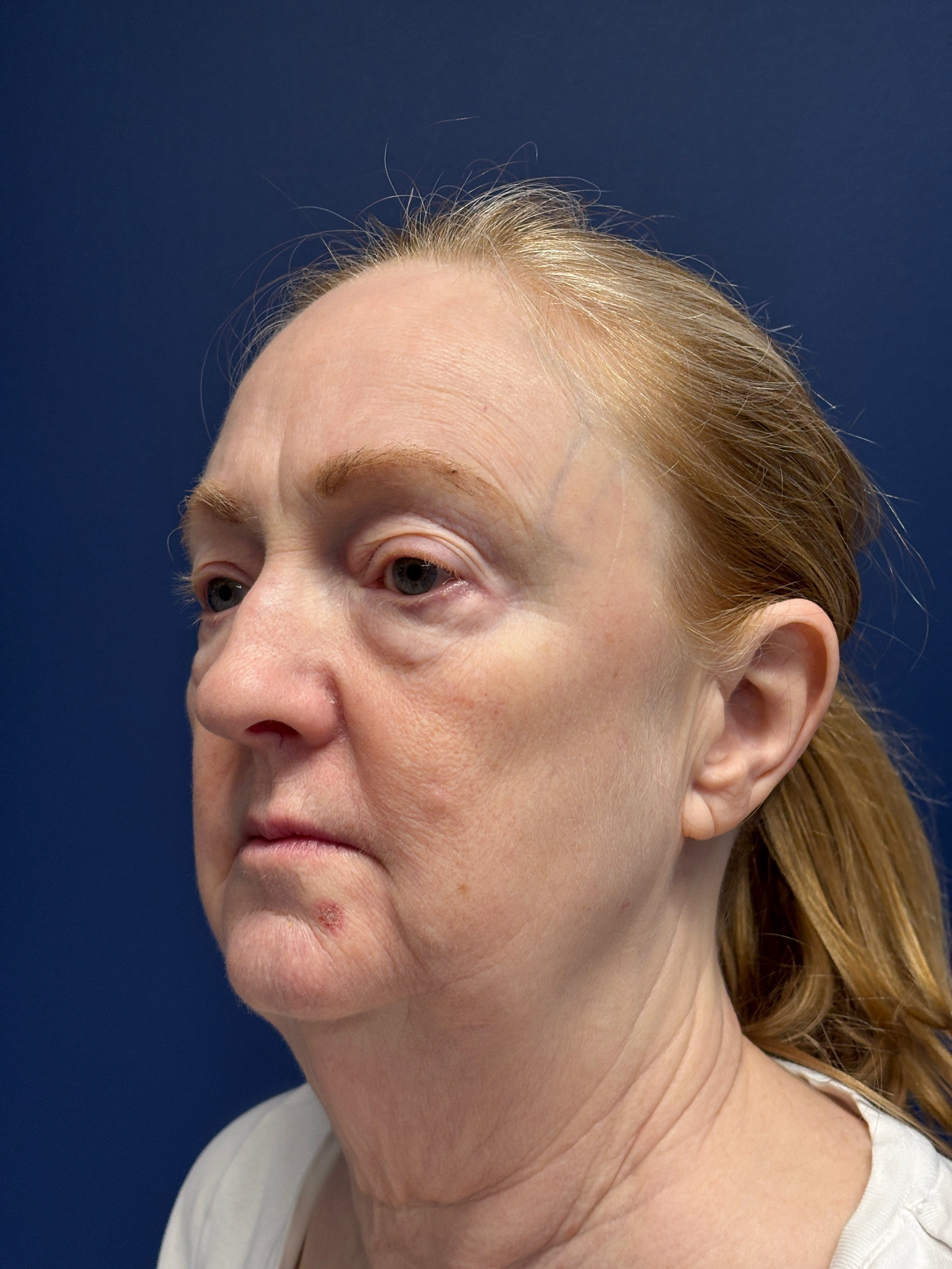 Facelift-Facial-Fat-Graft-Blepharoplasty-Necklift-Case--7934 | Before Eyelid Surgery 4