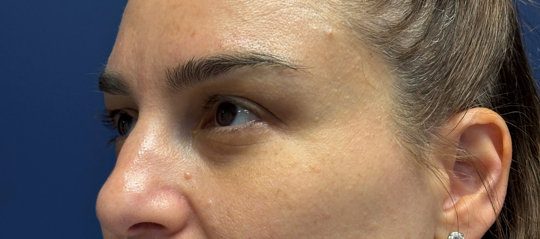 Blepharoplasty-Case--5118 | Before Eyelid Surgery 4