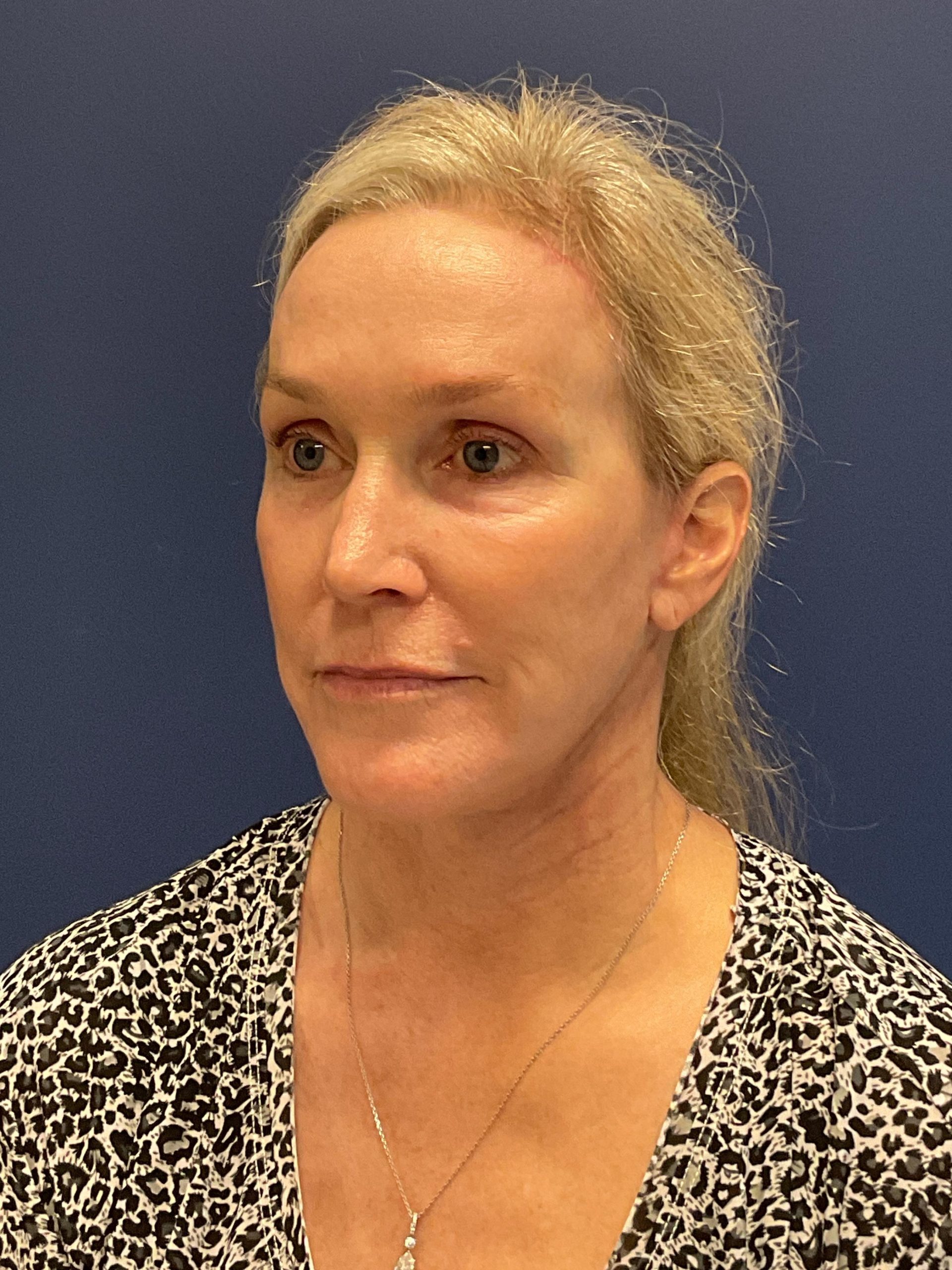 Facelift-Facial-Fat-Grafting-Brow-and-Neck-Lift-Case--9593 | After Brow Lift 5