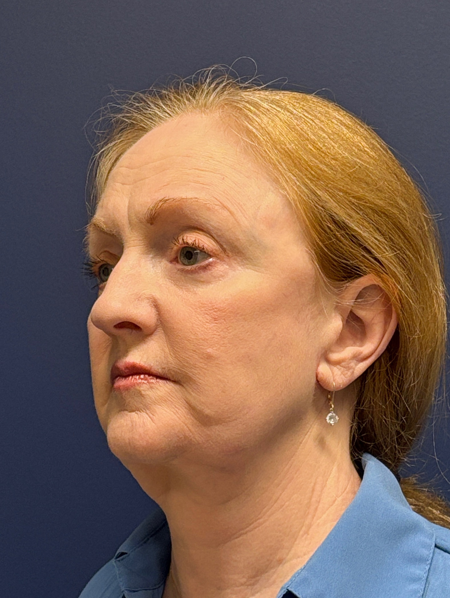 Facelift-Facial-Fat-Graft-Blepharoplasty-Necklift-Case--7934 | After Eyelid Surgery 4