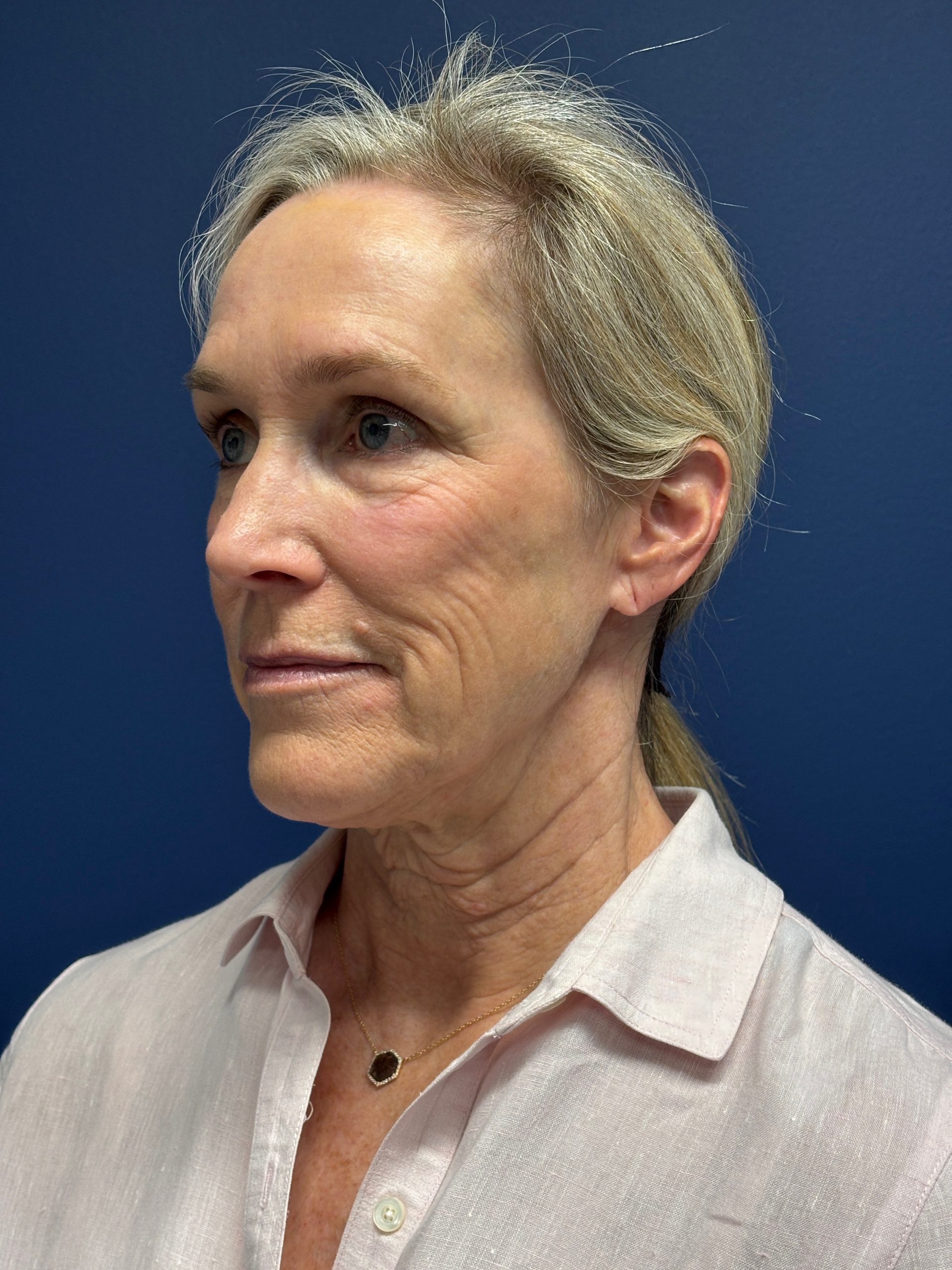 Facelift-Facial-Fat-Grafting-Brow-and-Neck-Lift-Case--9593 | Before Brow Lift 5