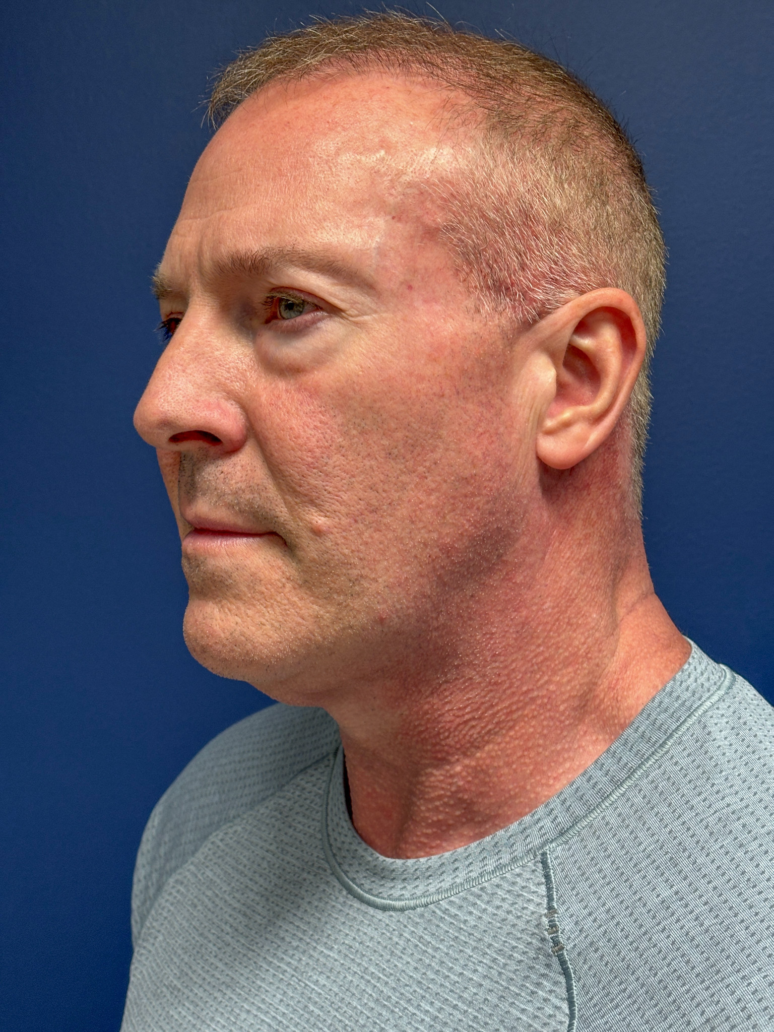 Facelift-Necklift-Blepharoplasty-Case--5535 | Before Eyelid Surgery 4