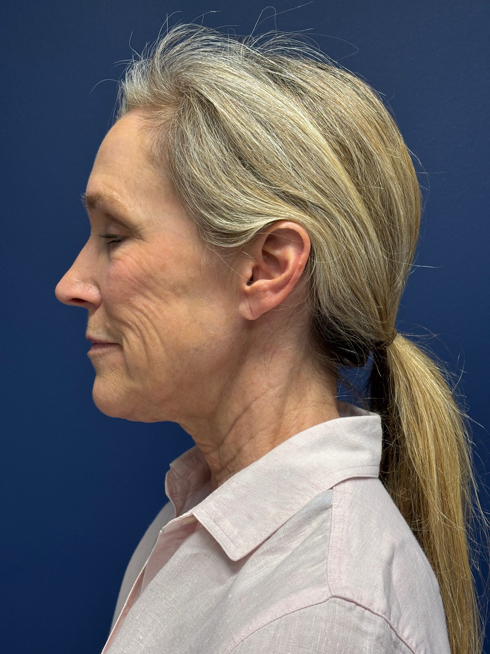 Facelift-Facial-Fat-Grafting-Brow-and-Neck-Lift-Case--9593 | Before Brow Lift 3