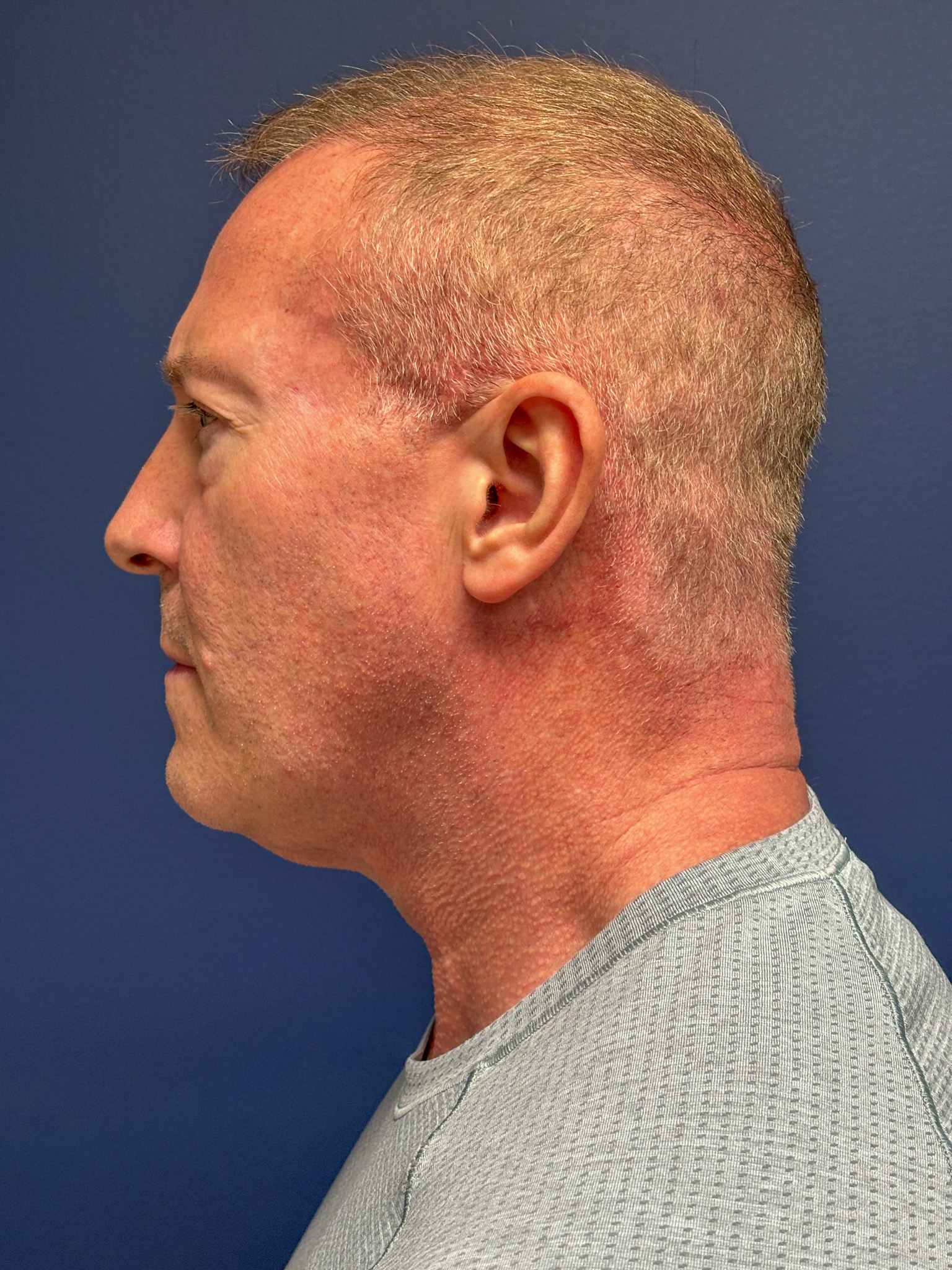 Facelift-Necklift-Blepharoplasty-Case--5535 | Before Dr. Arjun Kanuri 2