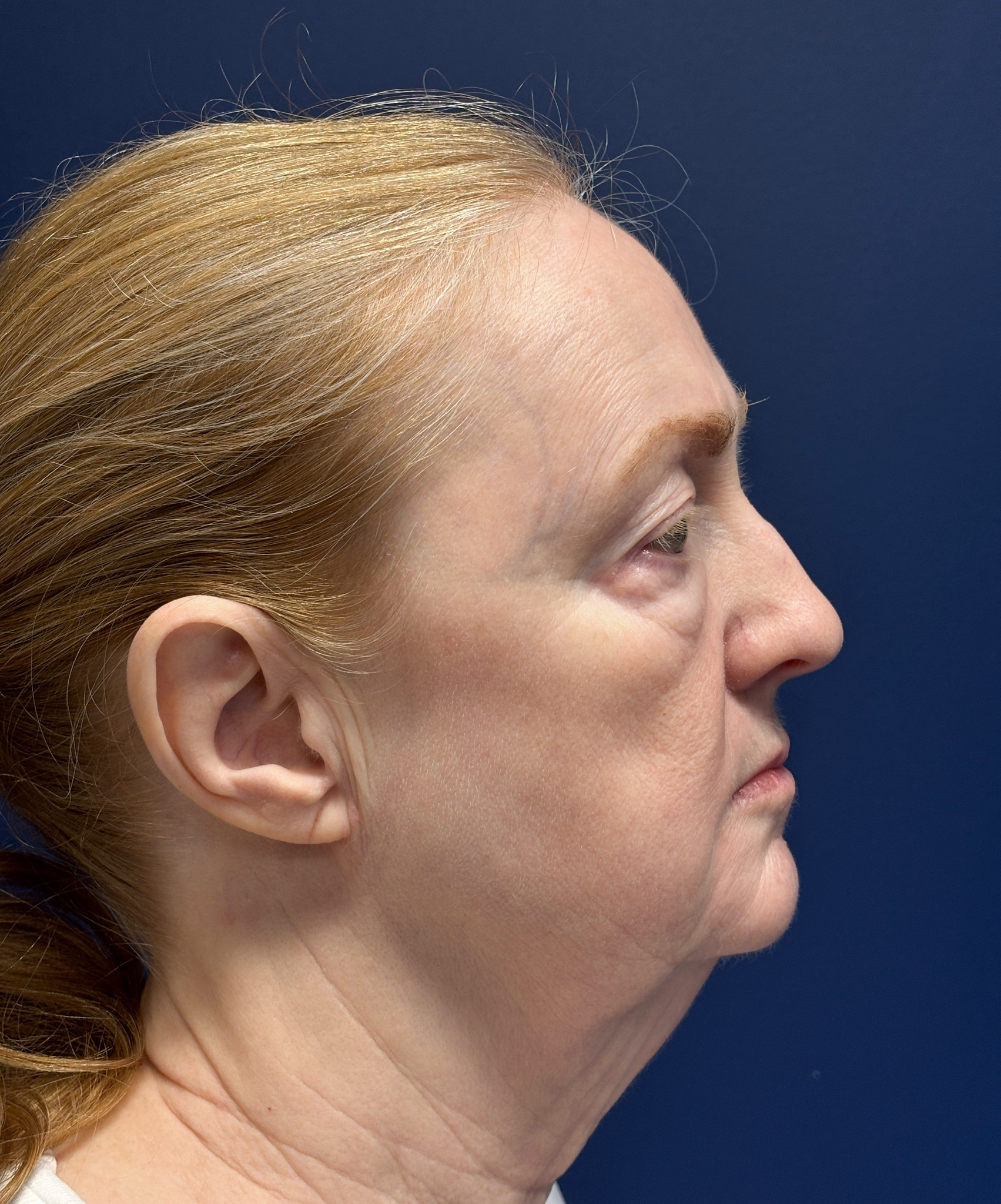 Facelift-Facial-Fat-Graft-Blepharoplasty-Necklift-Case--7934 | Before Eyelid Surgery 3