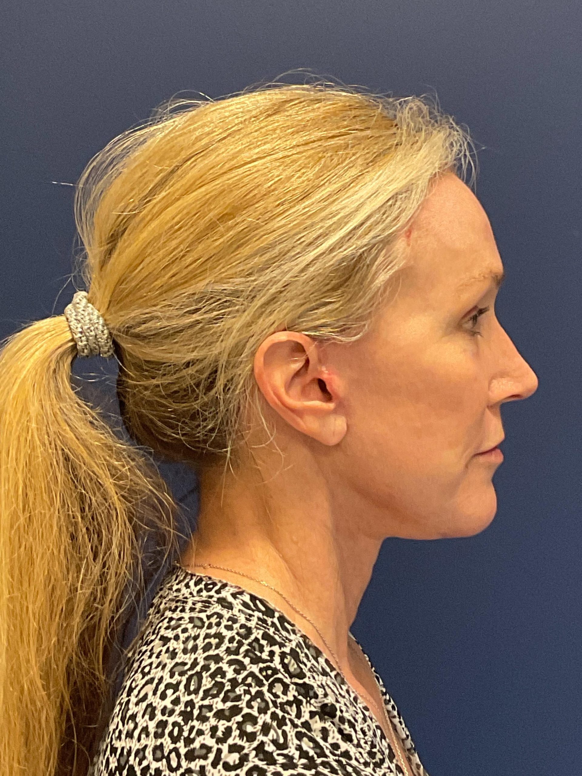 Facelift-Facial-Fat-Grafting-Brow-and-Neck-Lift-Case--9593 | After Facelift 2