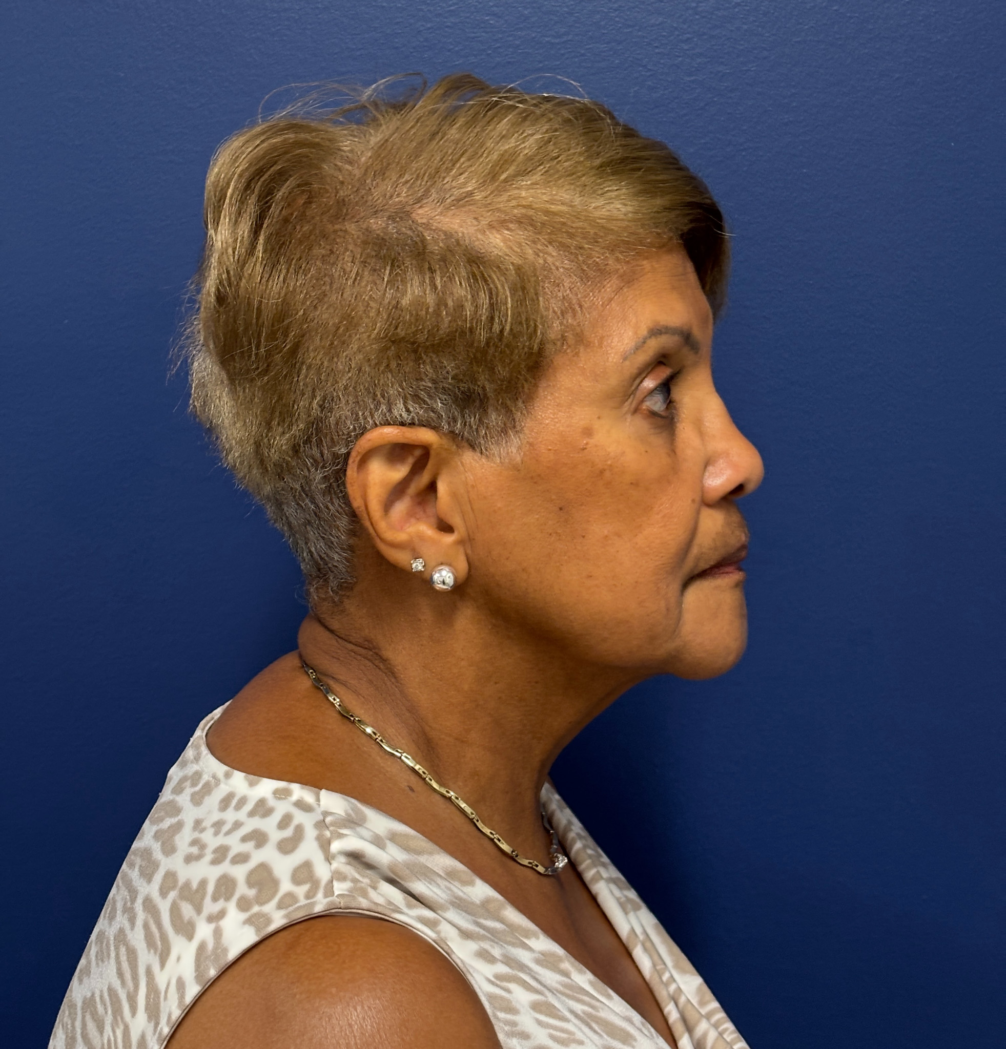 Facelift-Facial-Fat-Graft-Neck-Lift-Case--4262 | Before Dr. Arjun Kanuri 2
