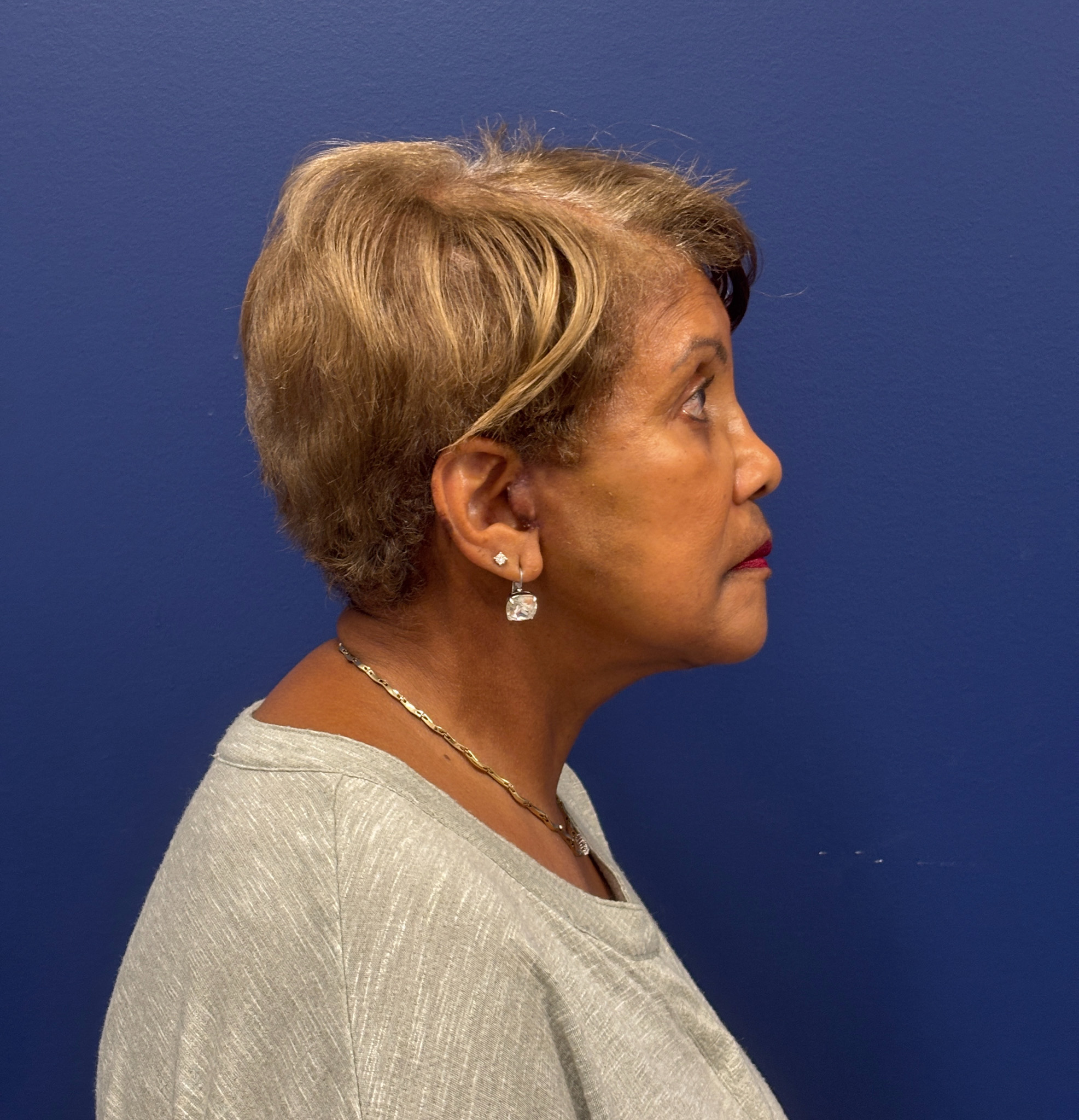 Facelift-Facial-Fat-Graft-Neck-Lift-Case--4262 | After Dr. Arjun Kanuri 2