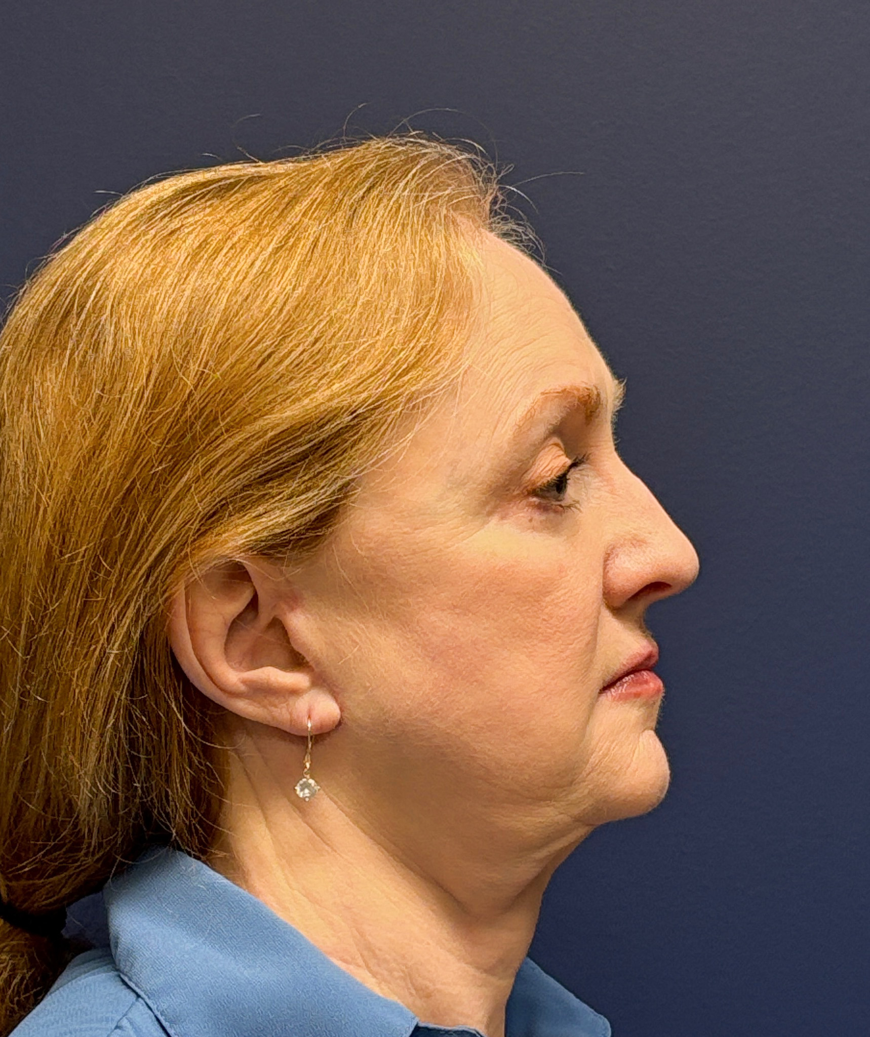 Facelift-Facial-Fat-Graft-Blepharoplasty-Necklift-Case--7934 | After Eyelid Surgery 3