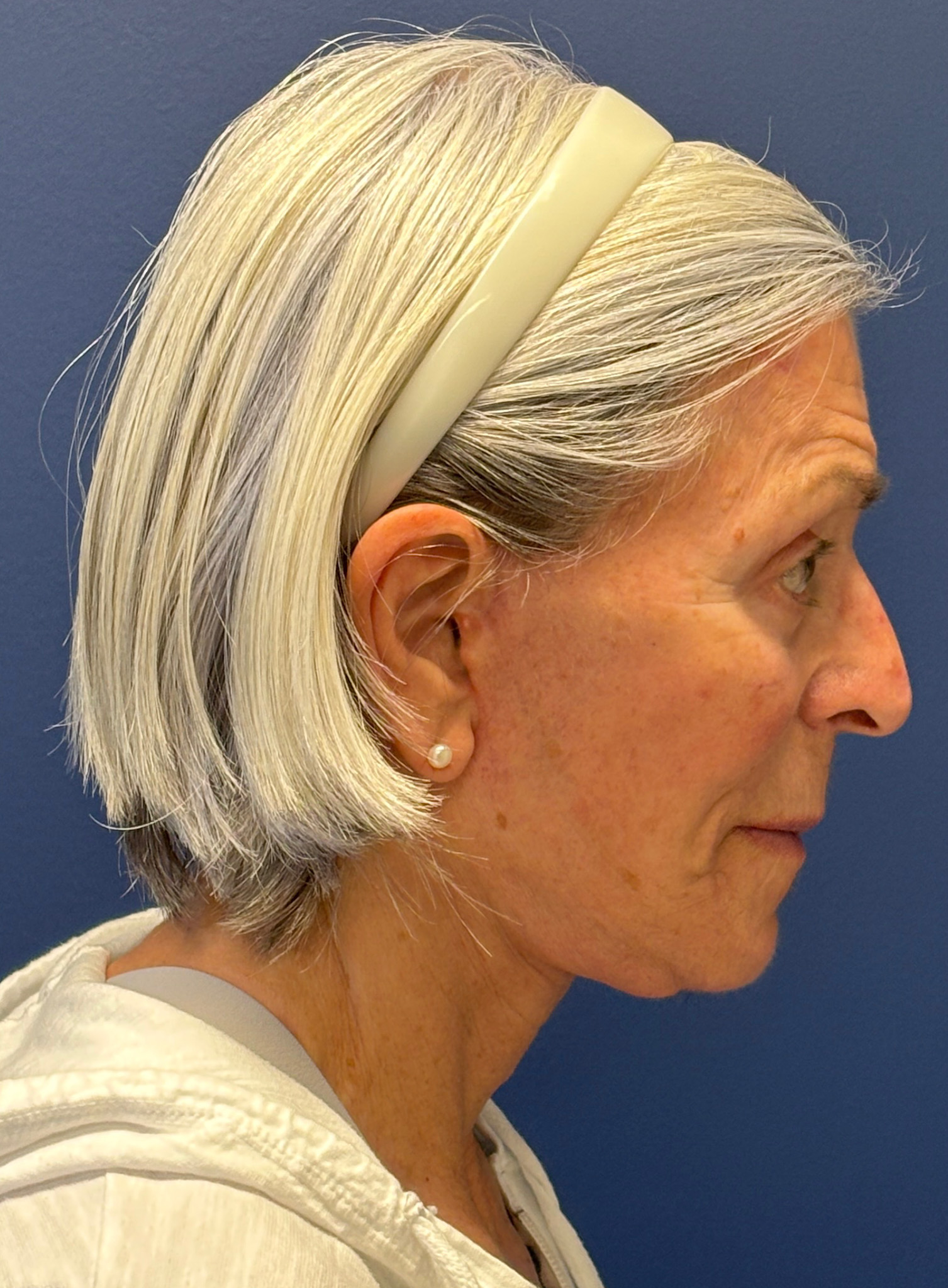 Facelift-Facial-Fat-Grafting-Browlift-Blepharoplasty-Necklift-Case--4176 | After Facial Fat Grafting 2