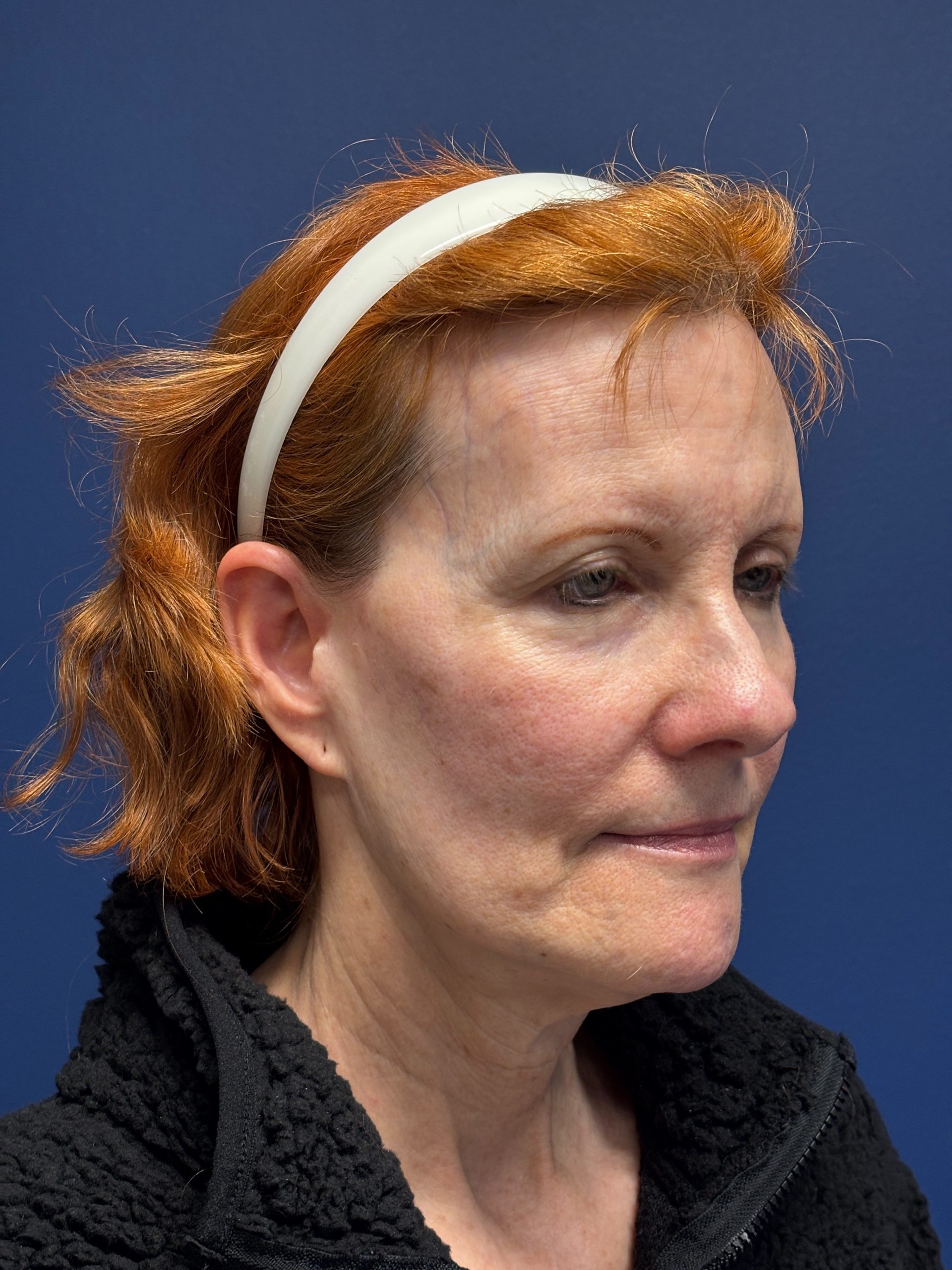 Facelift-Facial-Fat-Grafting-Neck-Lift-Case--6778 | Before Face360 5