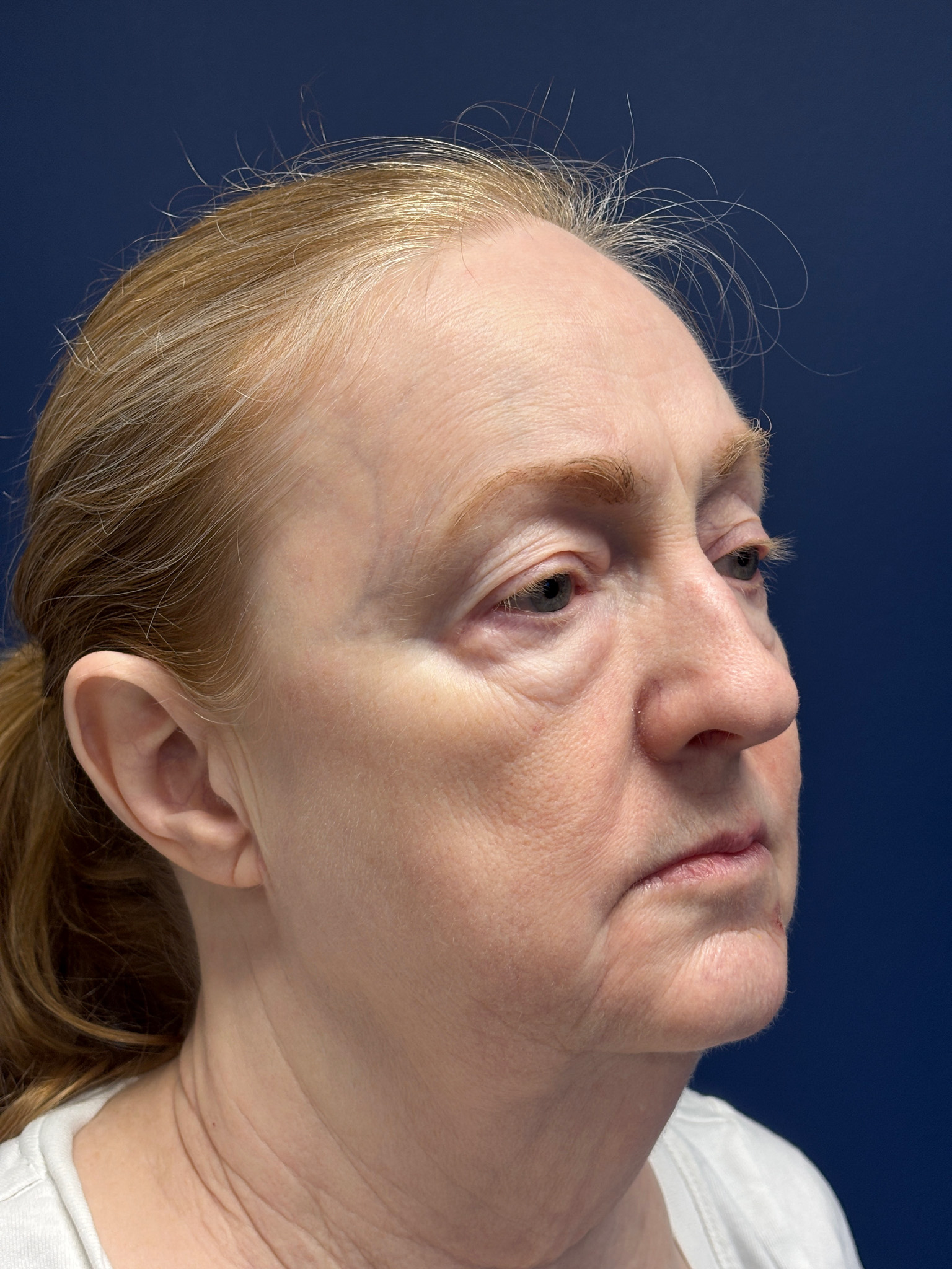 Facelift-Facial-Fat-Graft-Blepharoplasty-Necklift-Case--7934 | Before Eyelid Surgery 5