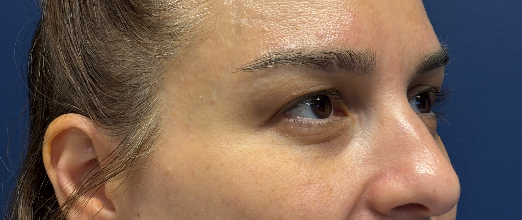 Blepharoplasty-Case--5118 | Before Eyelid Surgery 3