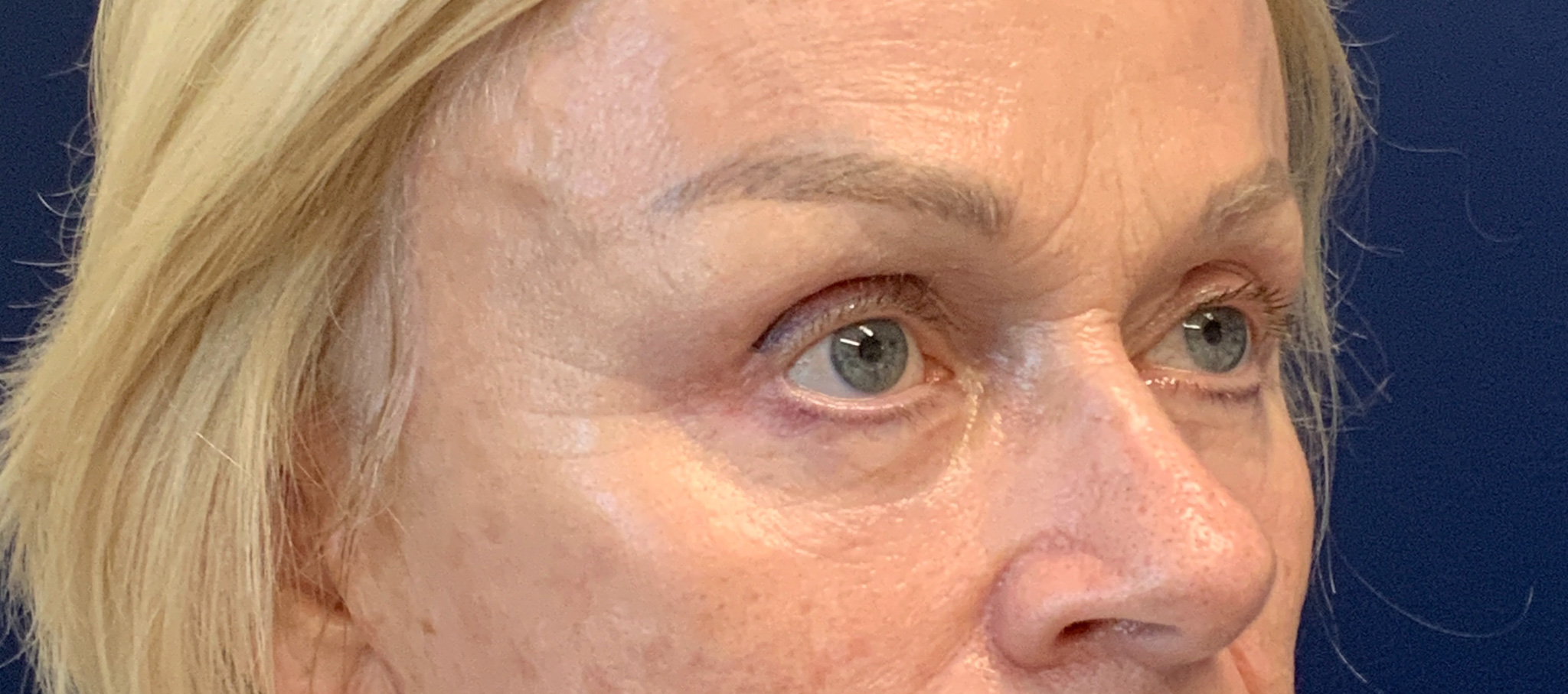 Blepharoplasty-and-Brow-Lift-Case--3108 | After Brow Lift 2