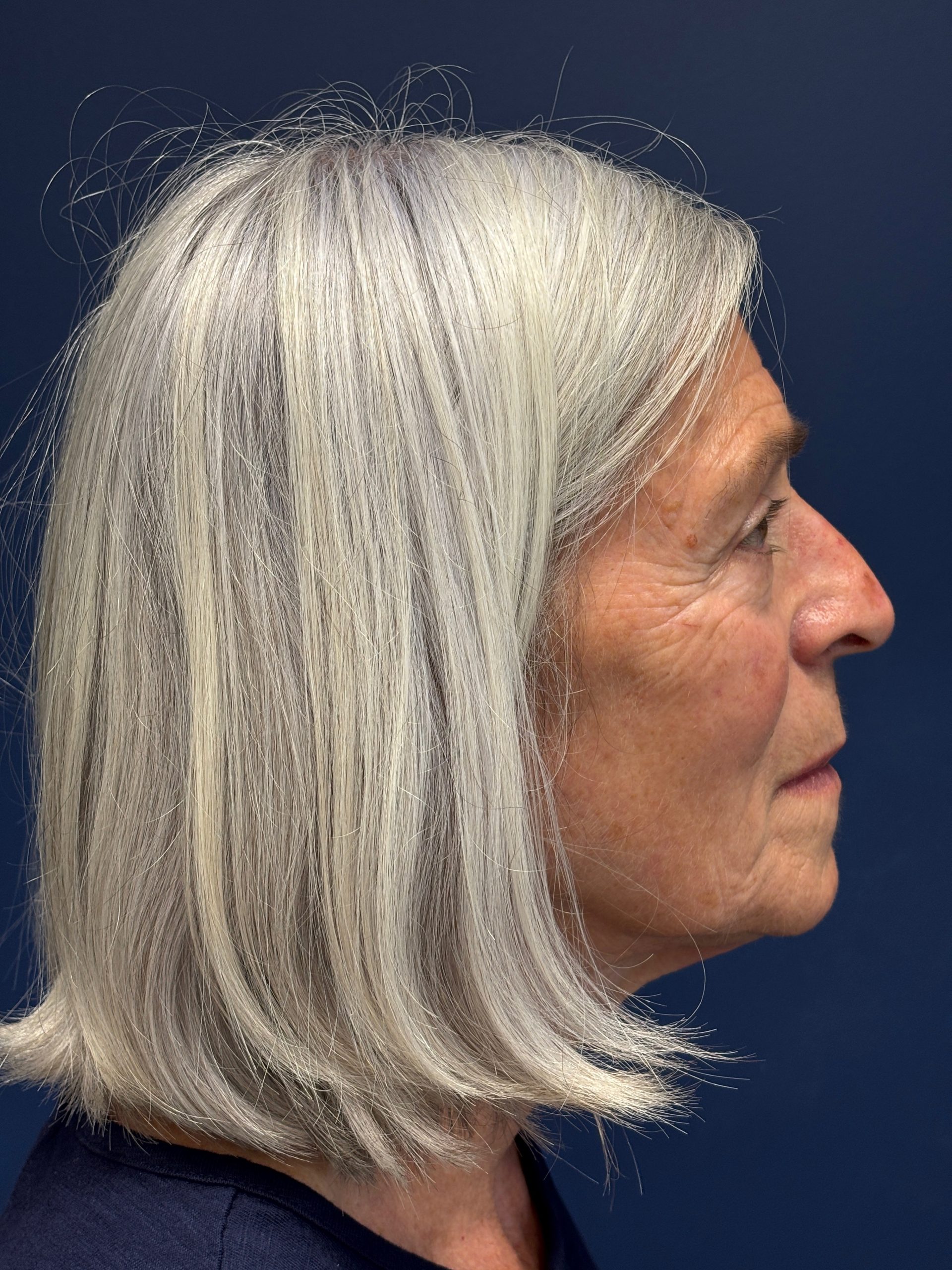 Facelift-Facial-Fat-Grafting-Browlift-Blepharoplasty-Necklift-Case--4176 | Before Facial Fat Grafting 2