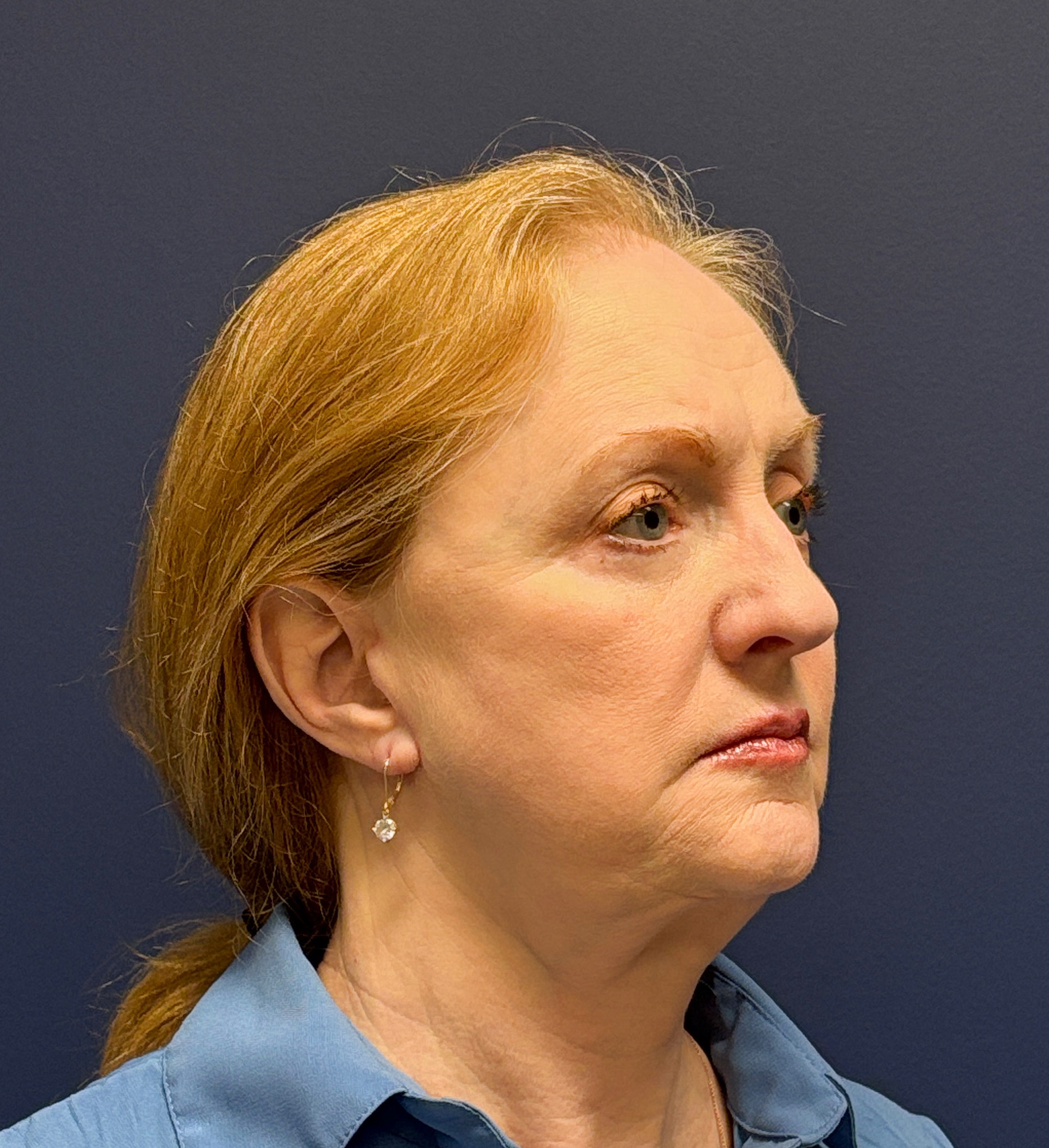 Facelift-Facial-Fat-Graft-Blepharoplasty-Necklift-Case--7934 | After Eyelid Surgery 5