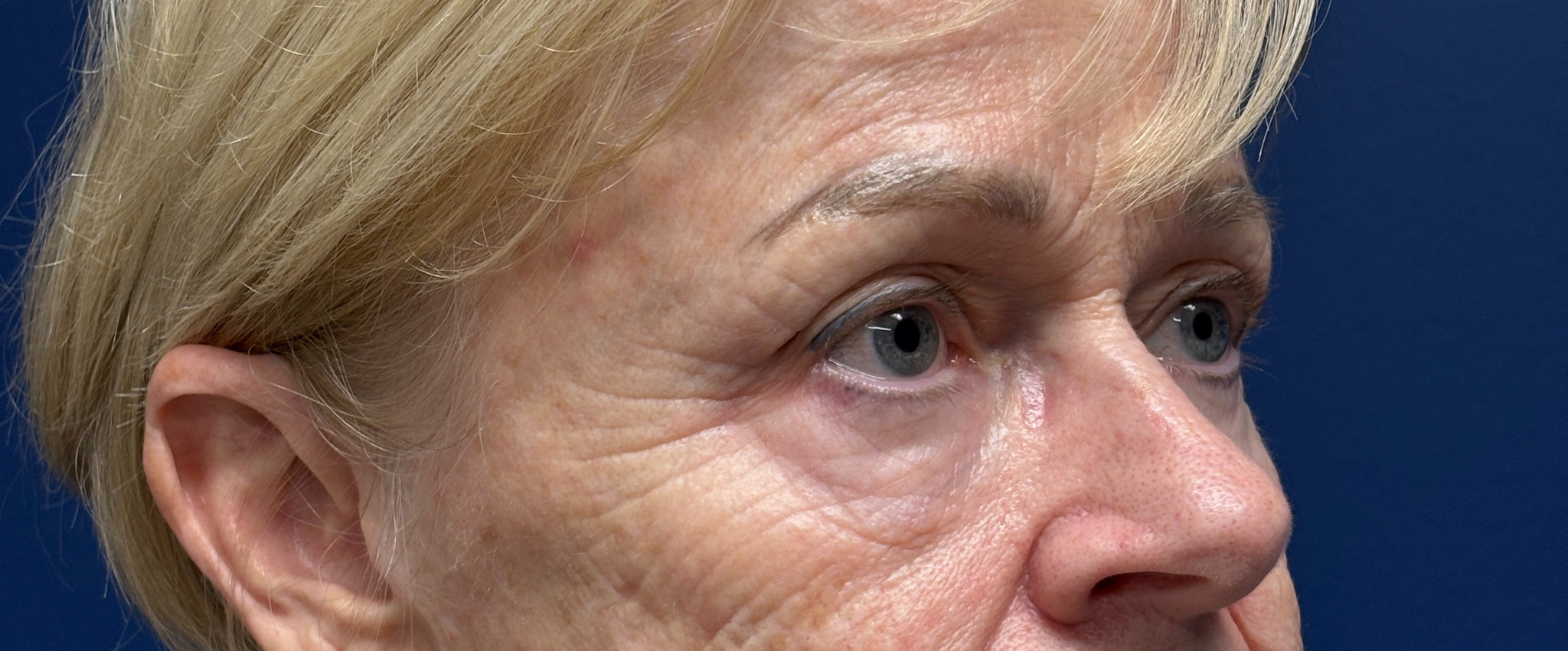 Blepharoplasty-and-Brow-Lift-Case--3108 | Before Brow Lift 2
