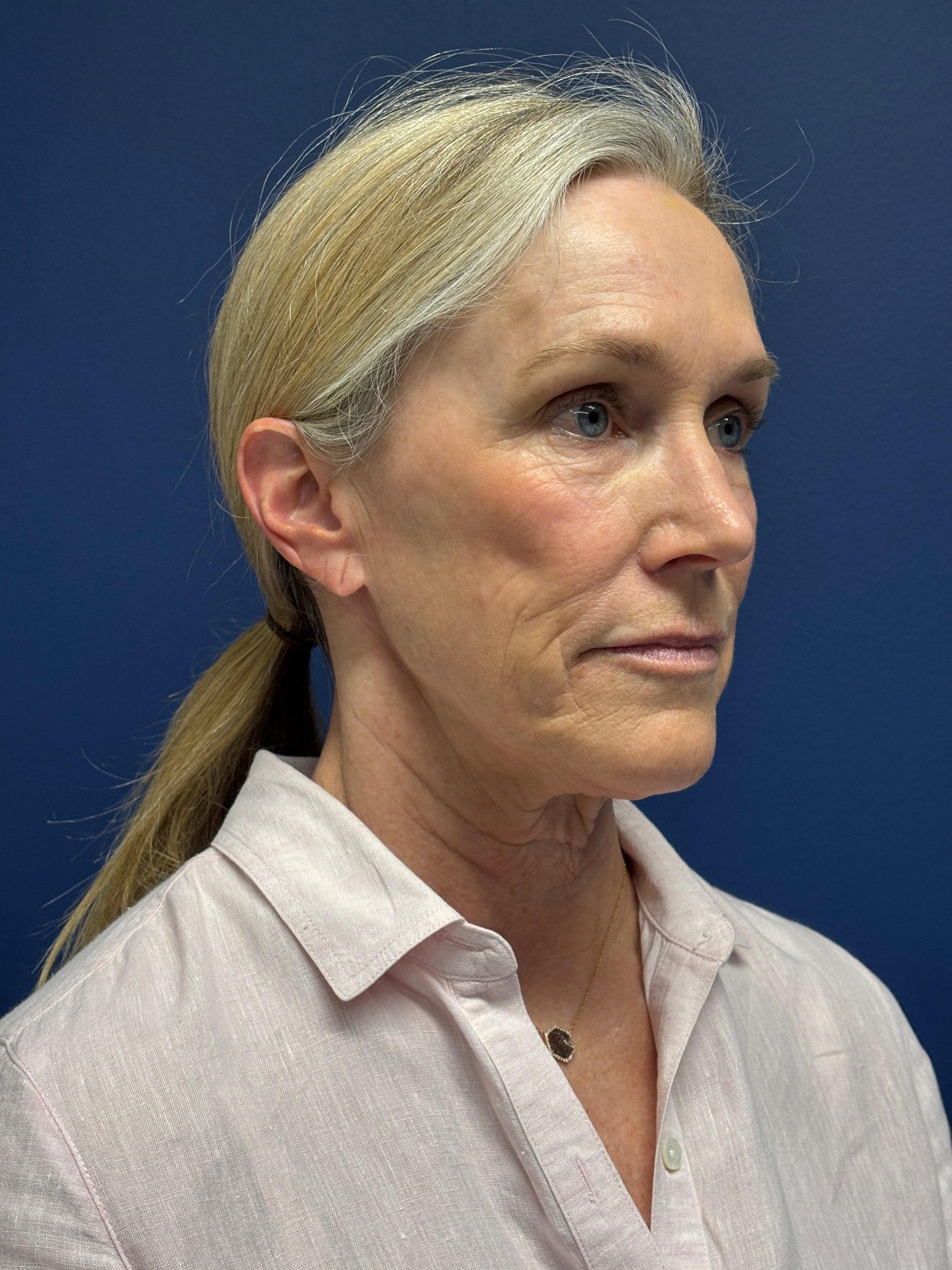 Facelift-Facial-Fat-Grafting-Brow-and-Neck-Lift-Case--9593 | Before Brow Lift 4
