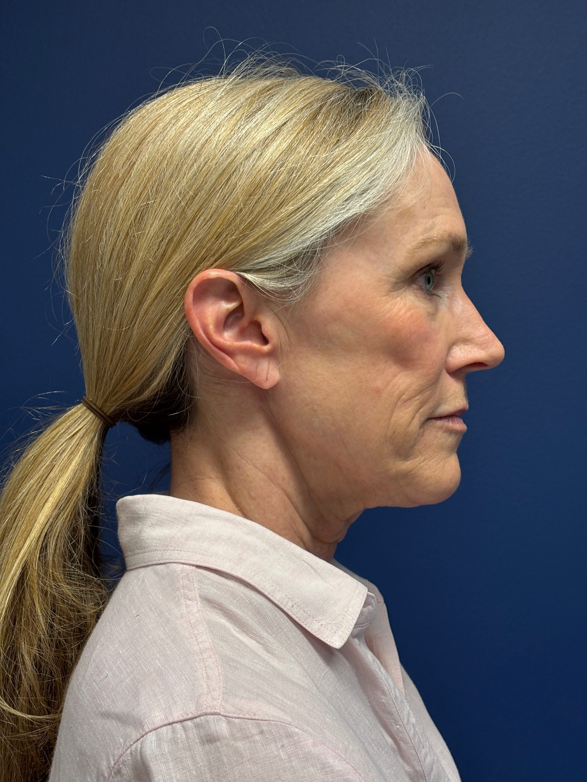 Facelift-Facial-Fat-Grafting-Brow-and-Neck-Lift-Case--9593 | Before Facelift 2