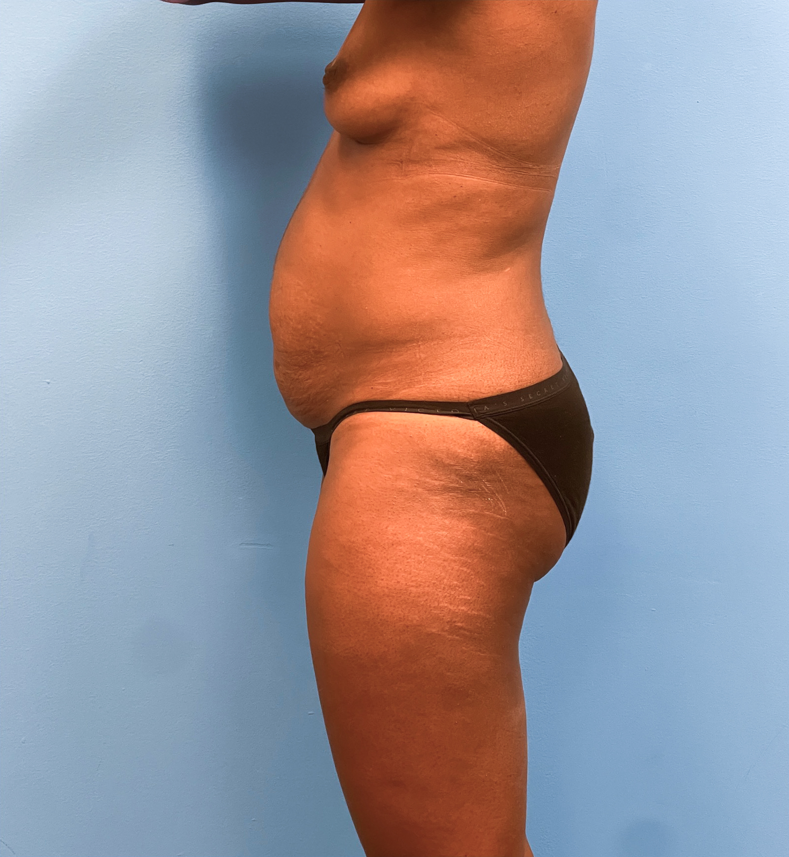 Abdominoplasty-Case--28134 | Before Tummy Tuck 3