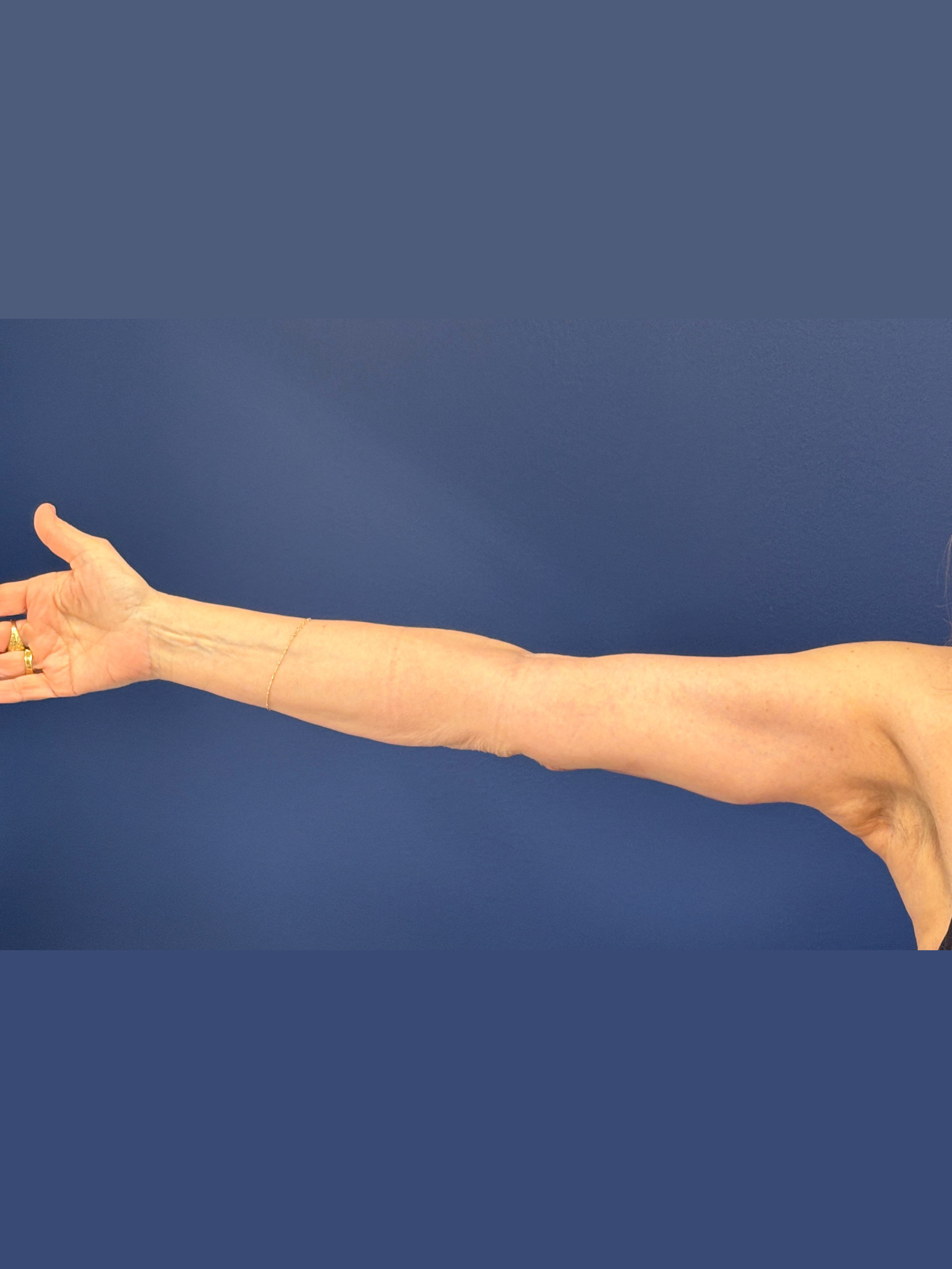 Brachioplasty-Case--3625 | After Arm Lift 6