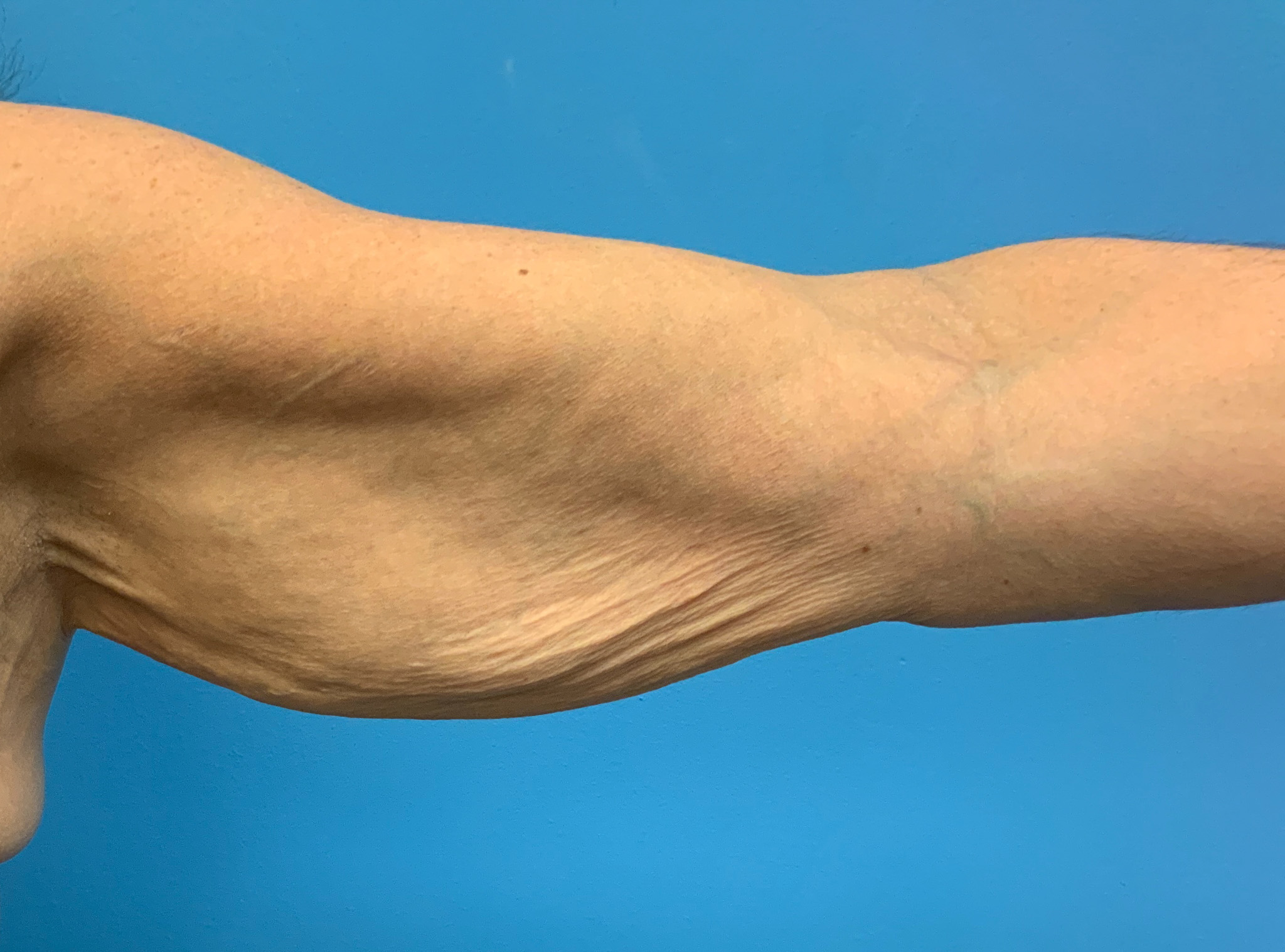 Brachioplasty-Case--2564 | Before Arm Lift 1