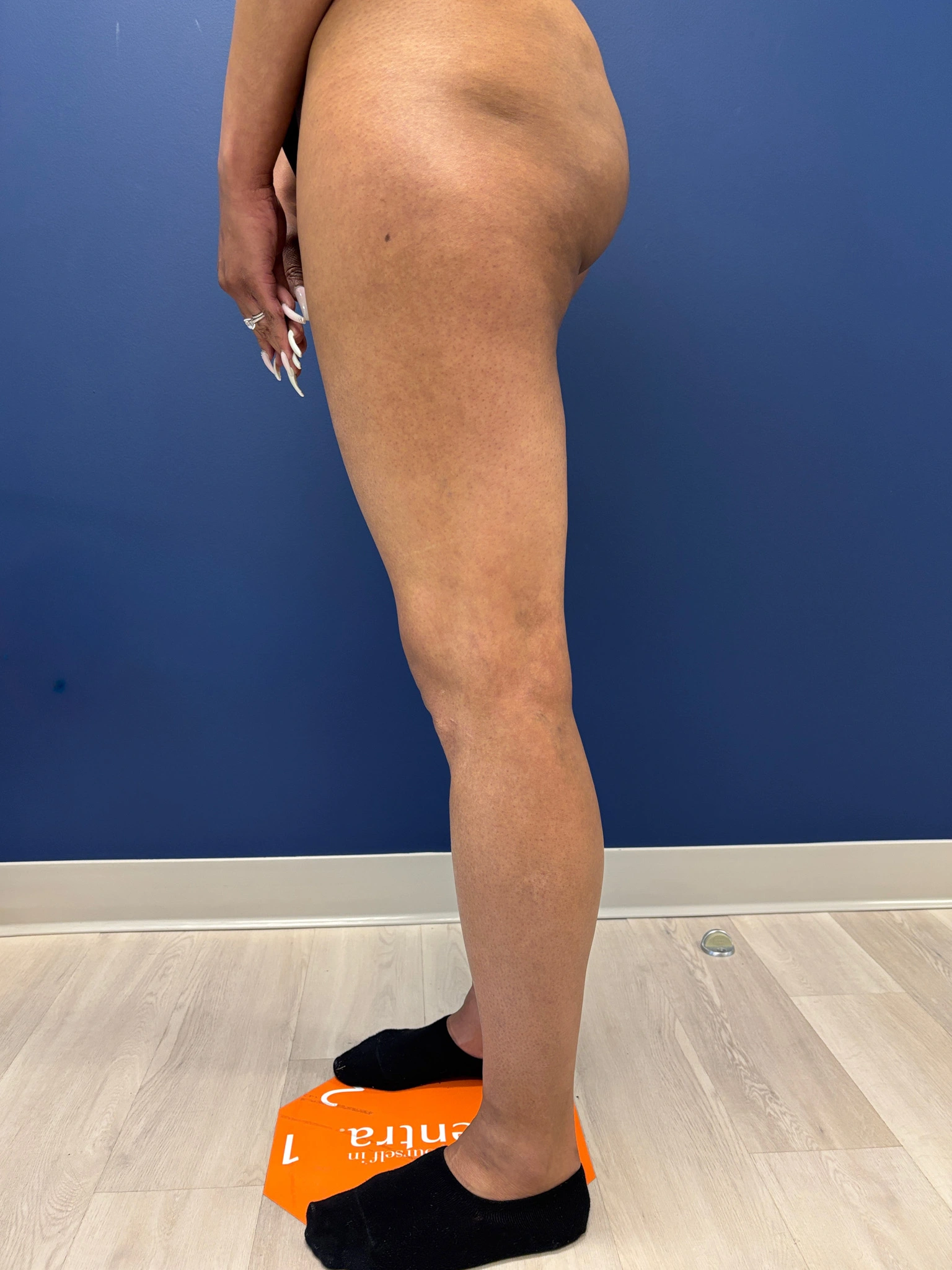 Lipo-360-Case--8130 | After Liposuction 7